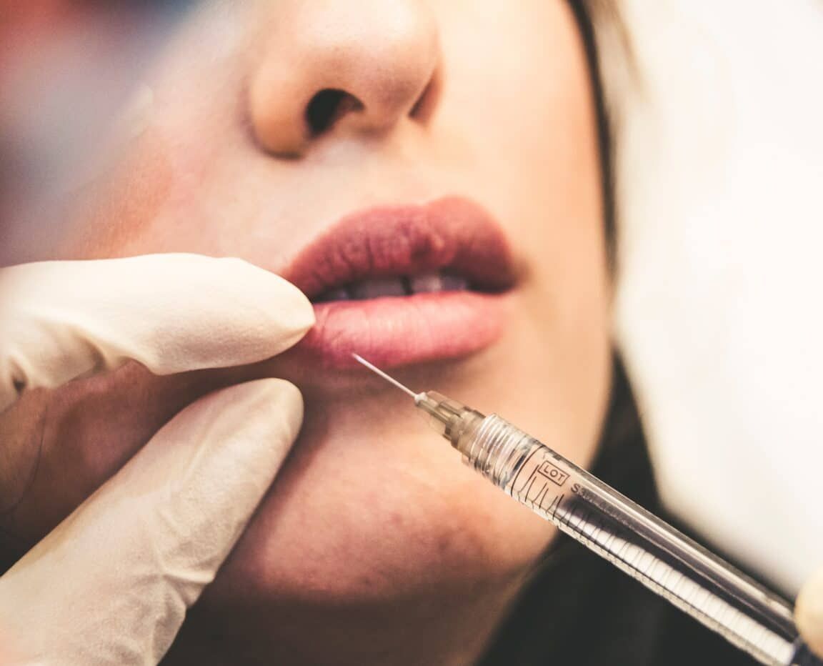 What Filler is Best for Lips?