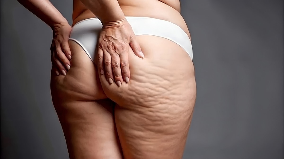 Do Cellulite Treatments Work? : Why Aveli Is Different From Lasers, Creams, and Massage Devices