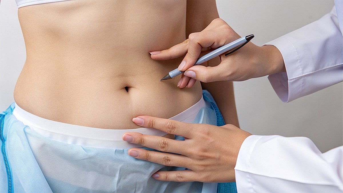 How to Minimize Scars After a Mommy Makeover Featured Image -Medical professional marking abdomen for procedure