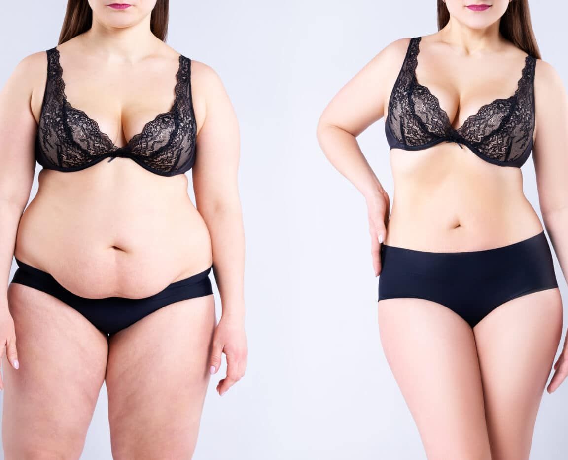 Choosing the Right Procedures for Your Mommy Makeover: Customizing Your Transformation