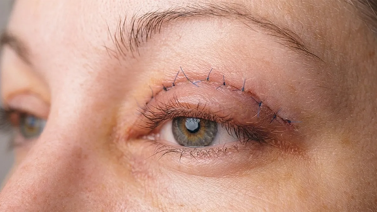 Upper Eyelid Surgery Blepharoplasty