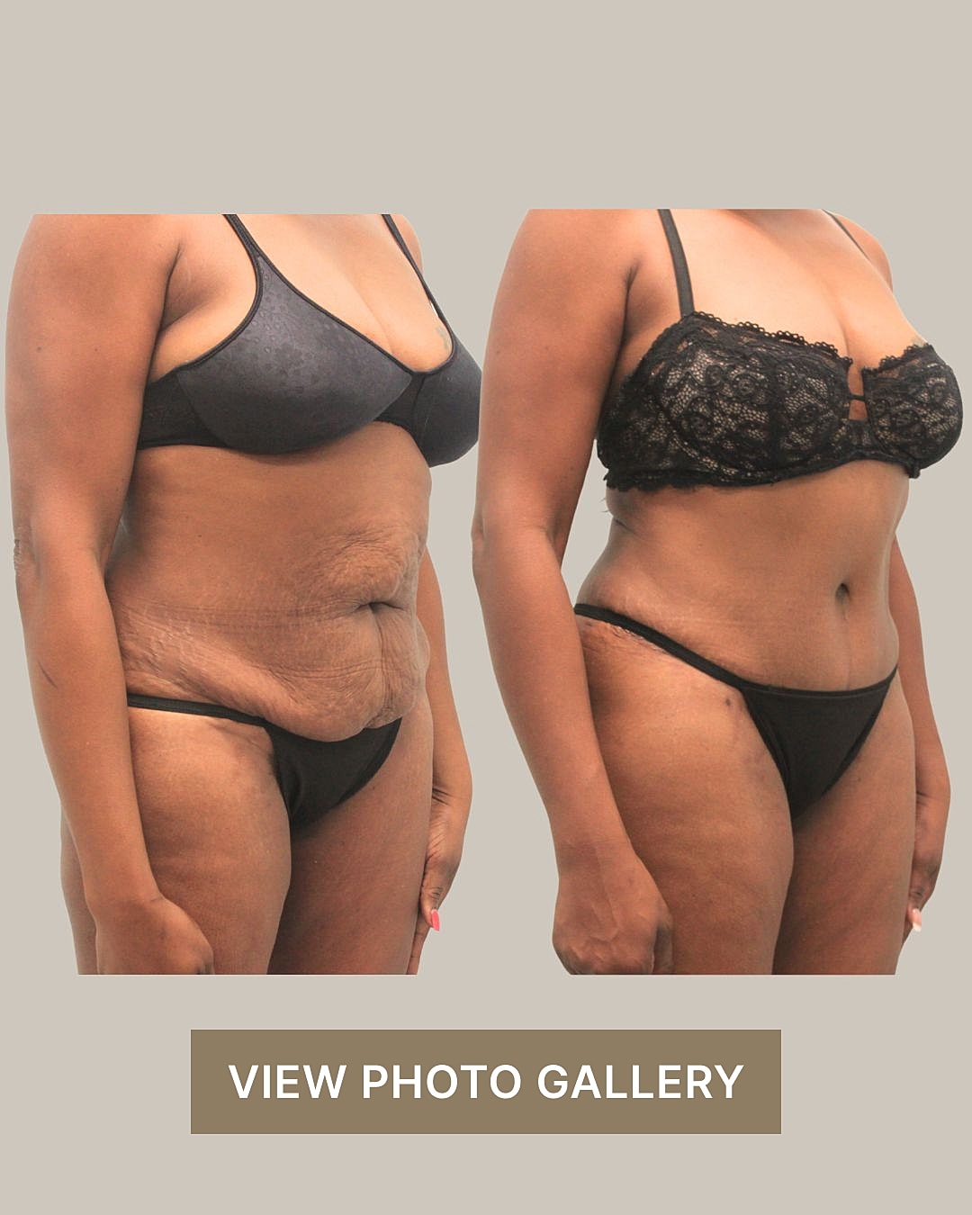 Houston Tummy Tuck before and after body transformation comparison.