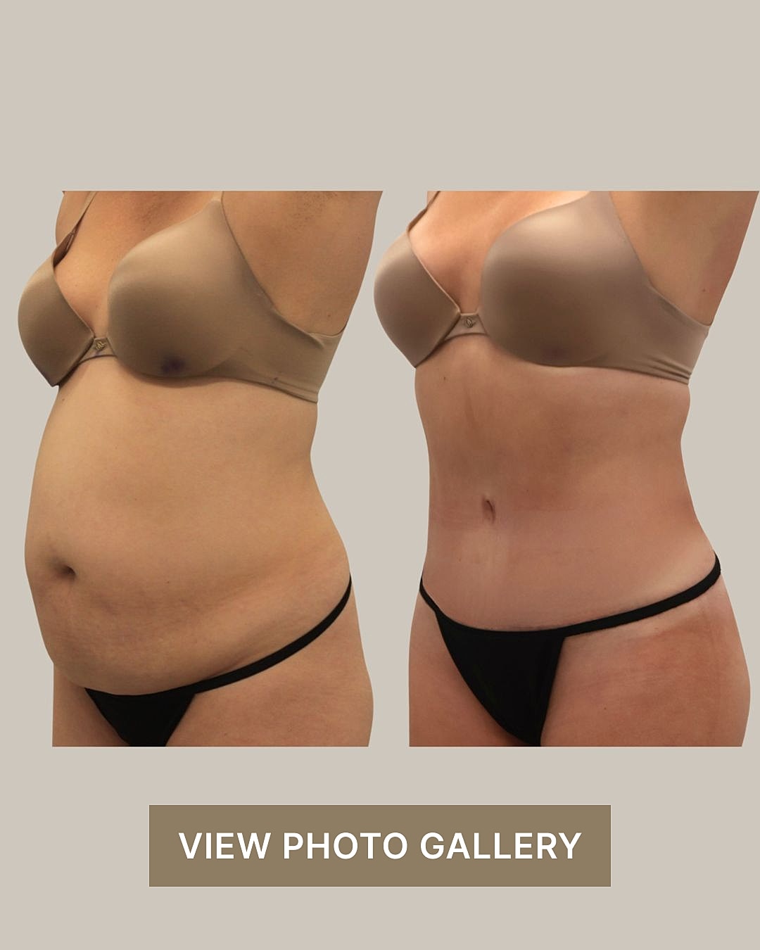 Before and after tummy tuck in Houston image.