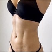 Houston body contouring patient after