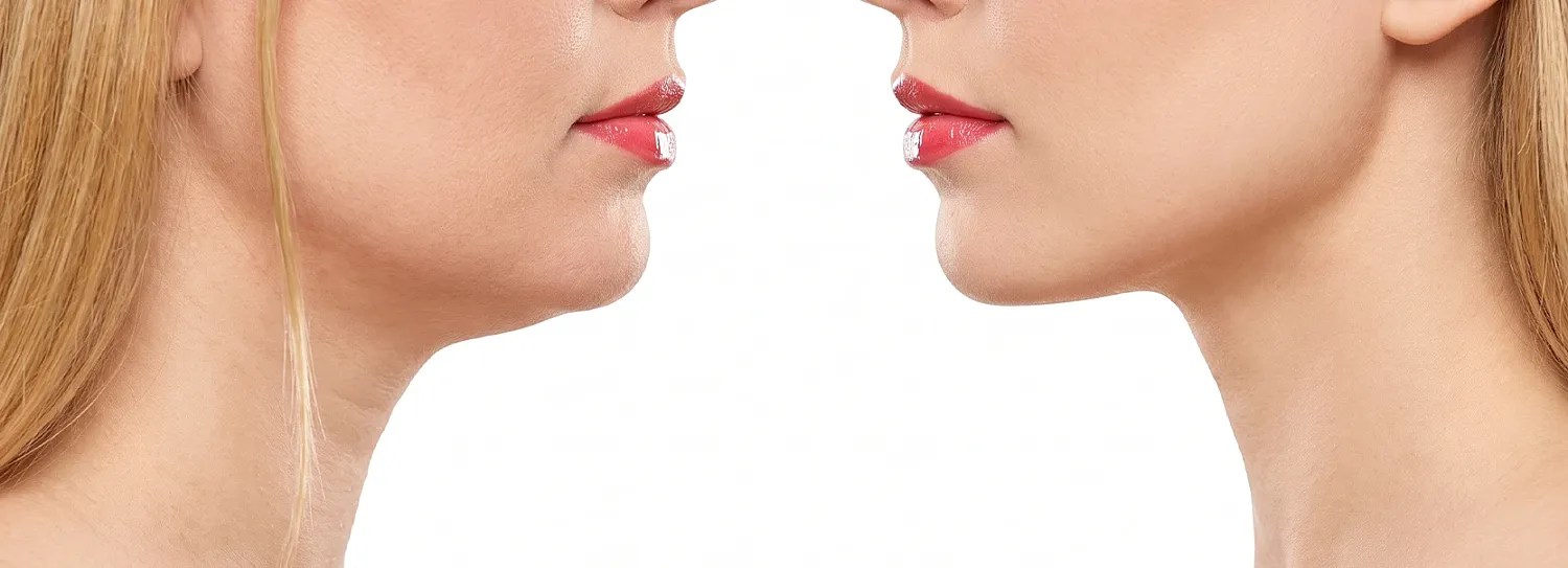 Neck Lift vs. Chin Liposuction - Images Added
