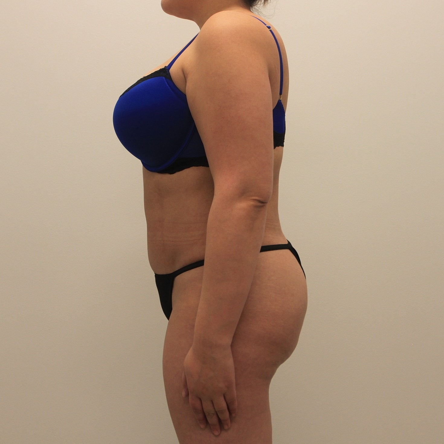 Tummy Tuck Before & After