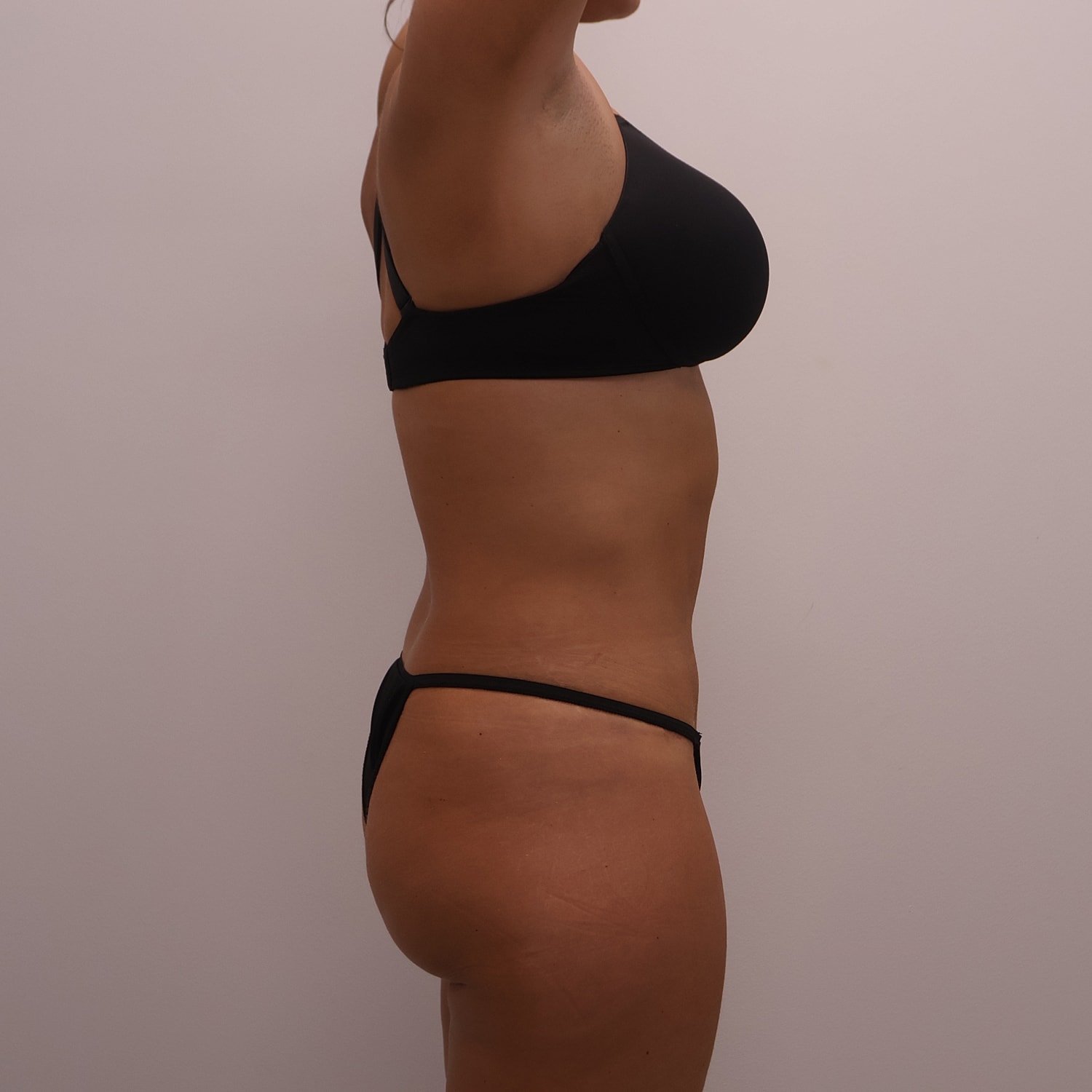 Tummy Tuck Before & After