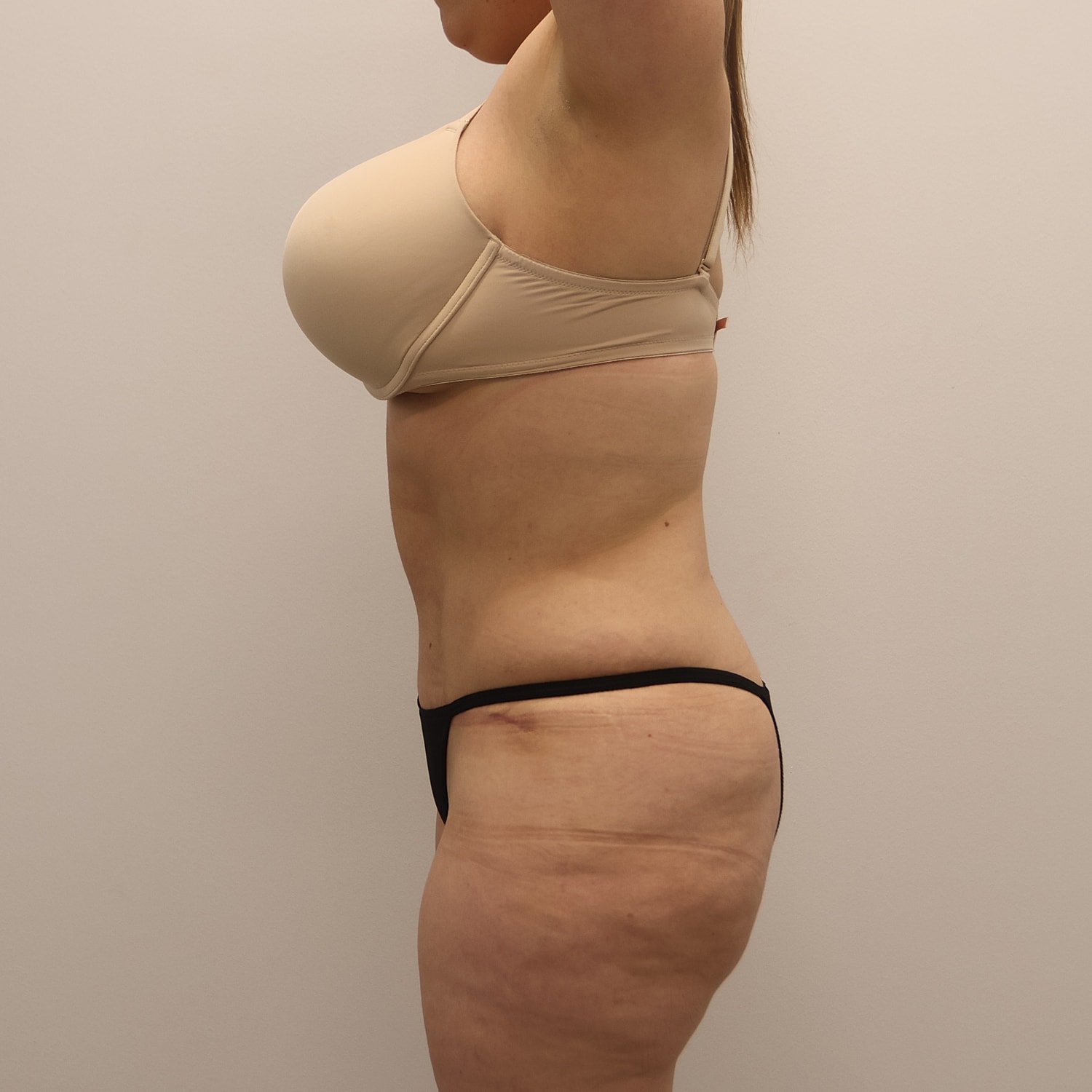 Tummy Tuck Before & After