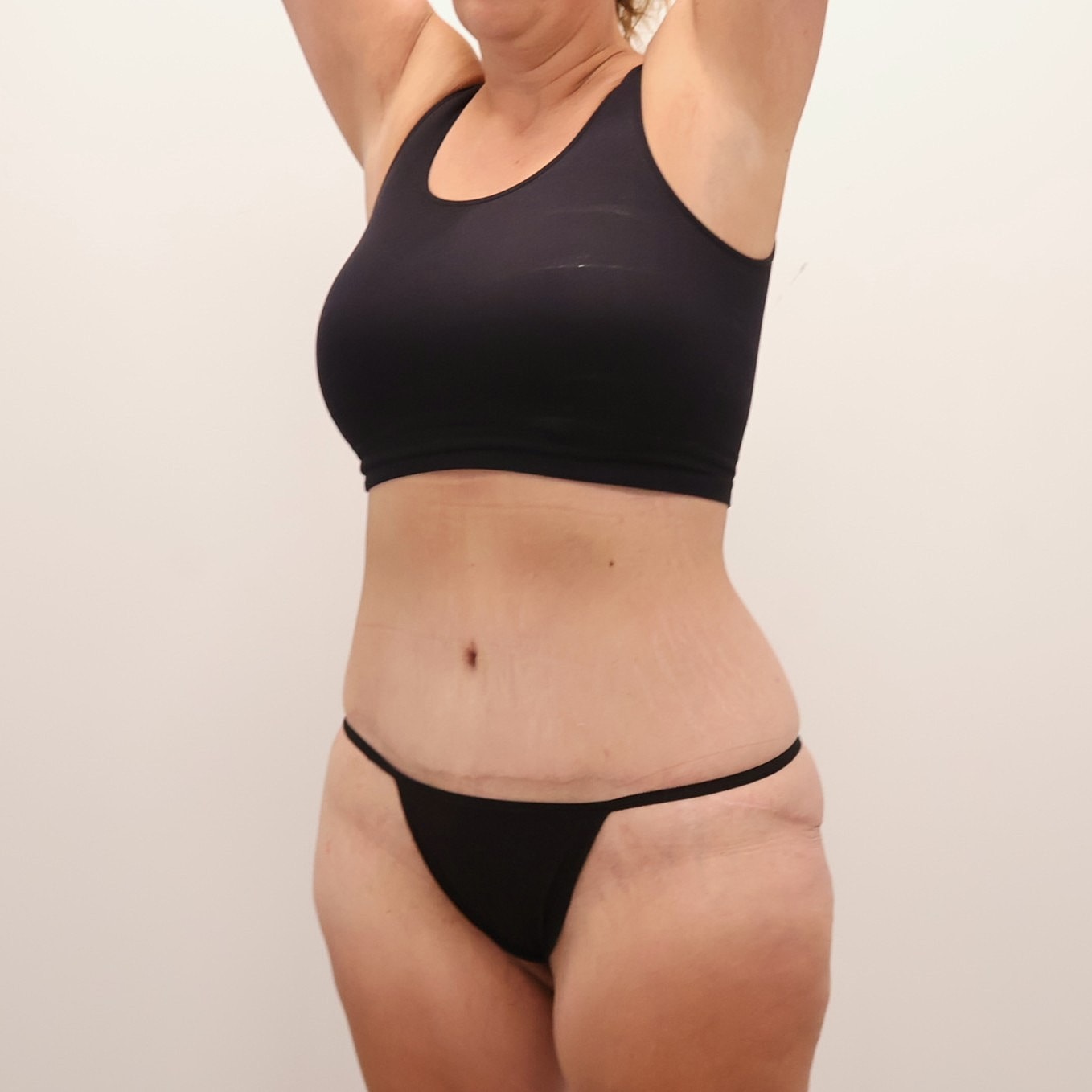 Tummy Tuck Before & After