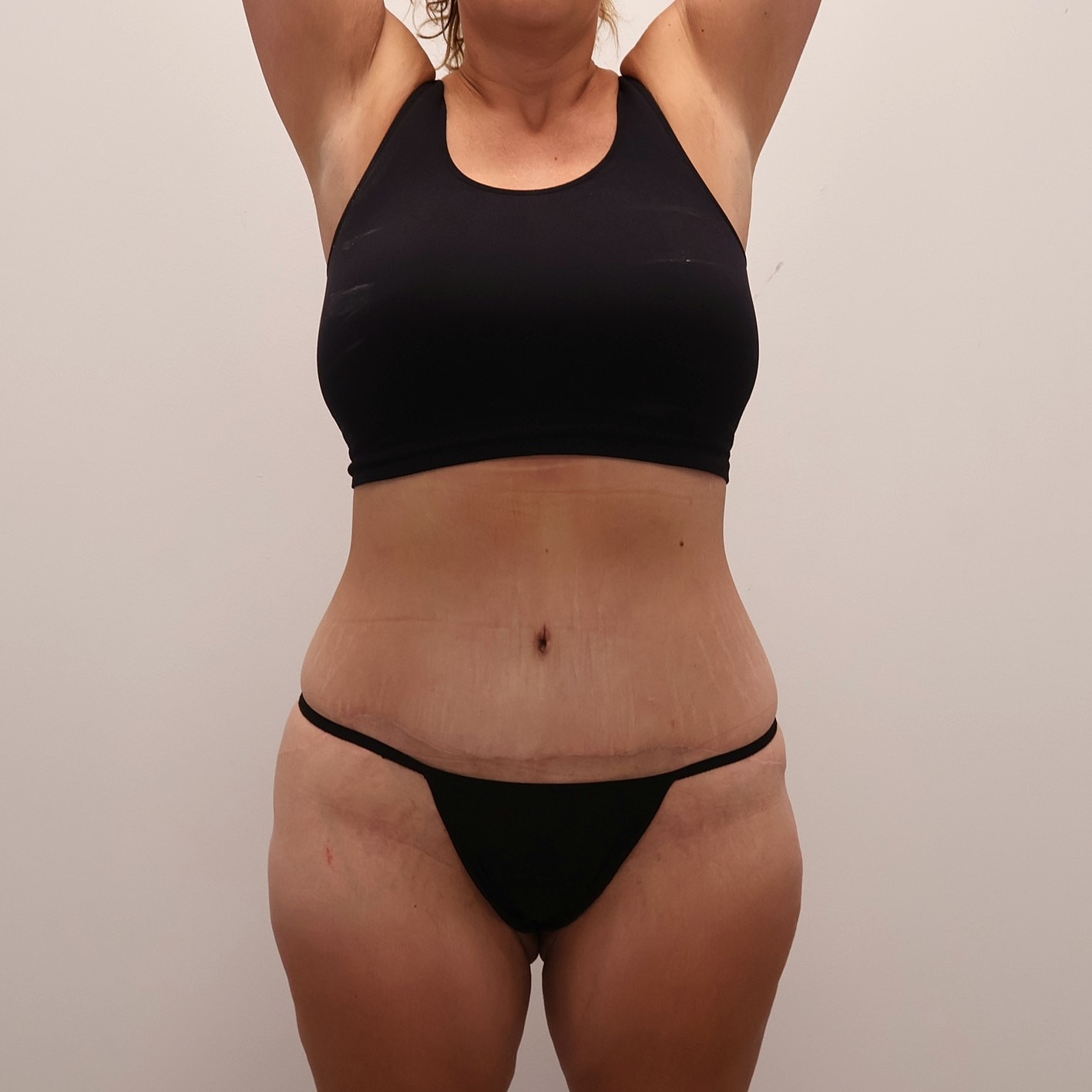 Tummy Tuck Before & After