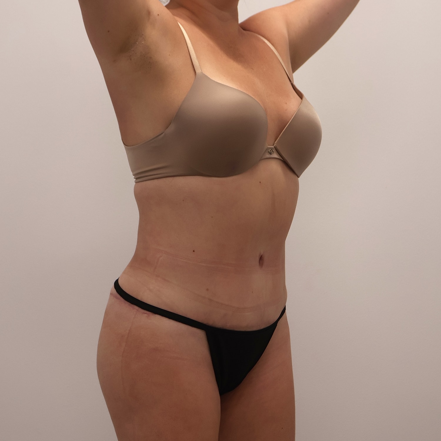 Tummy Tuck Before & After