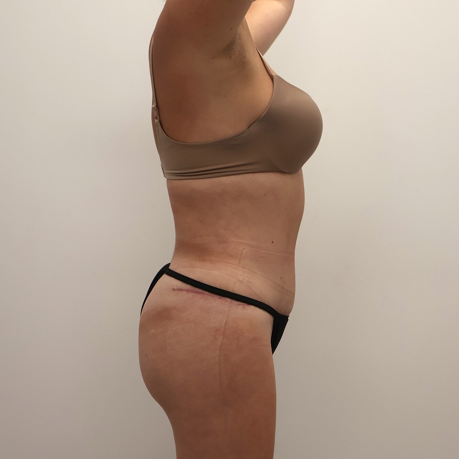 Tummy Tuck Before & After