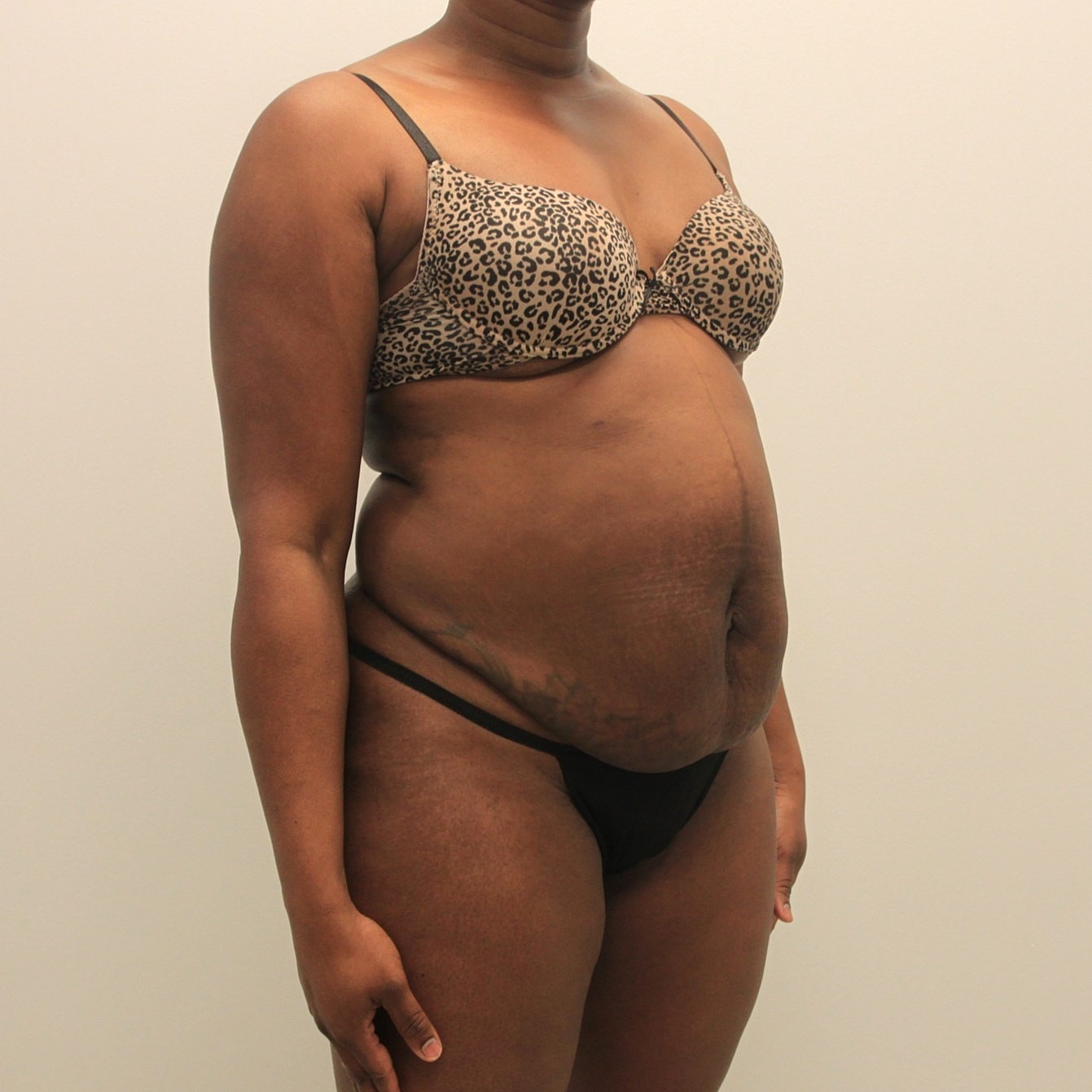 Tummy Tuck Before & After