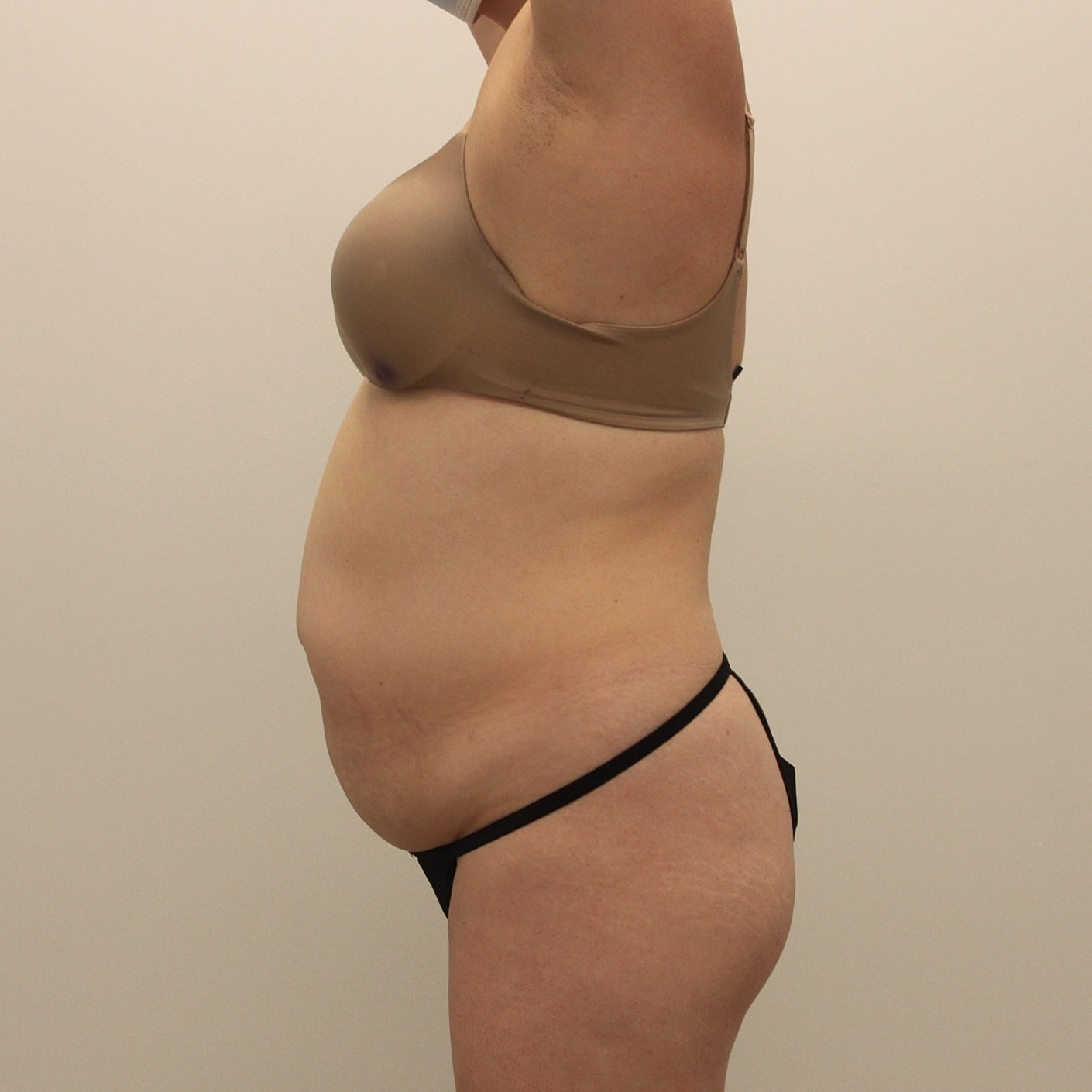 Tummy Tuck Before & After