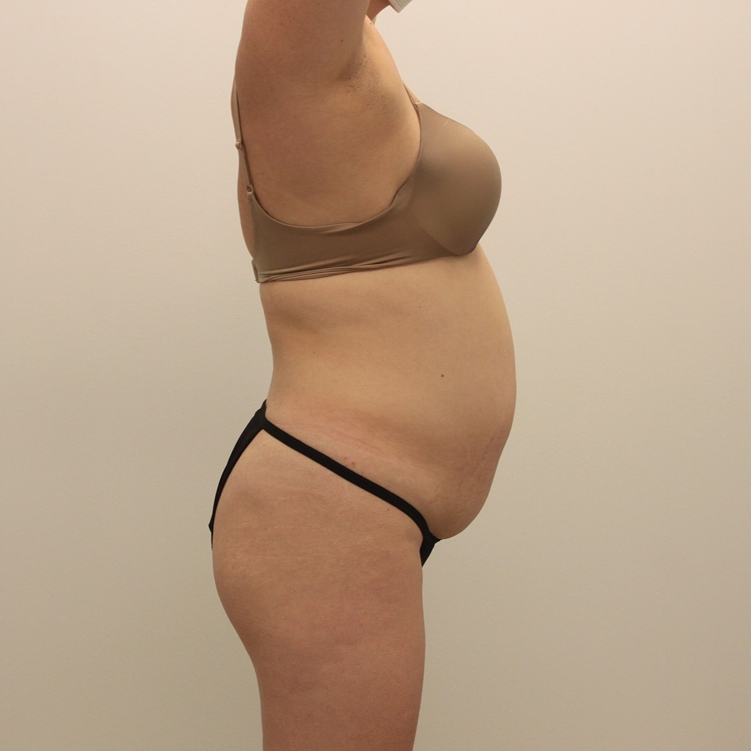 Tummy Tuck Before & After