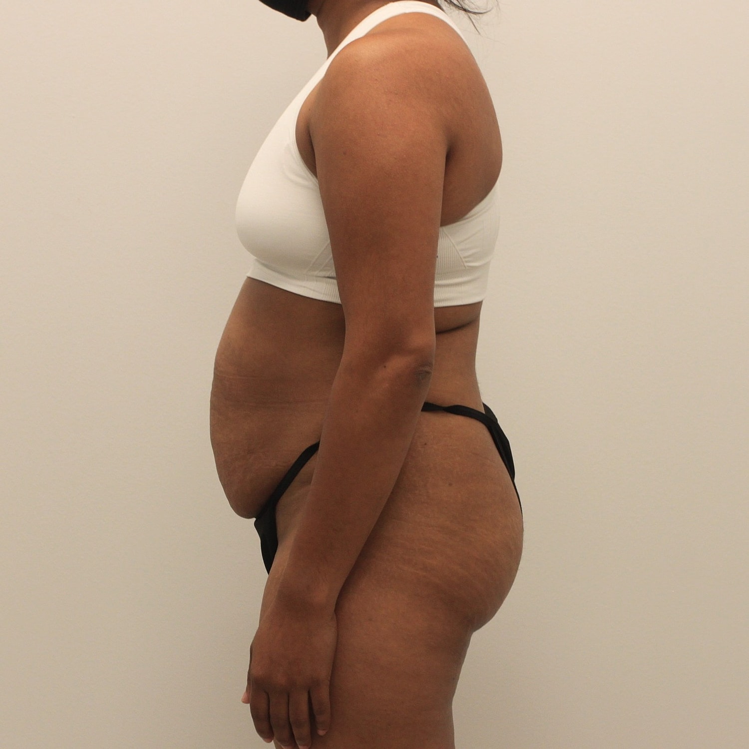 Tummy Tuck Before & After