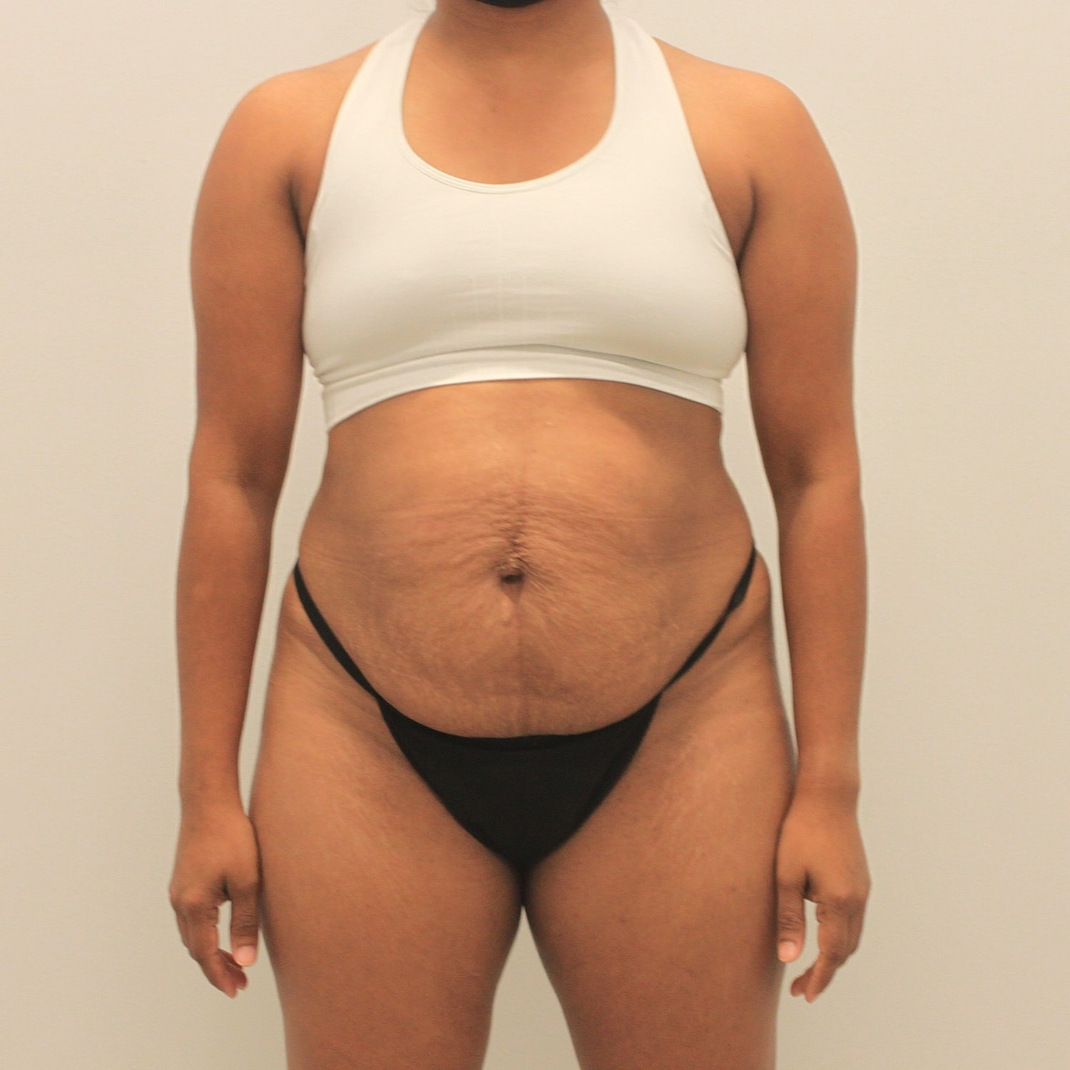 Tummy Tuck Before & After