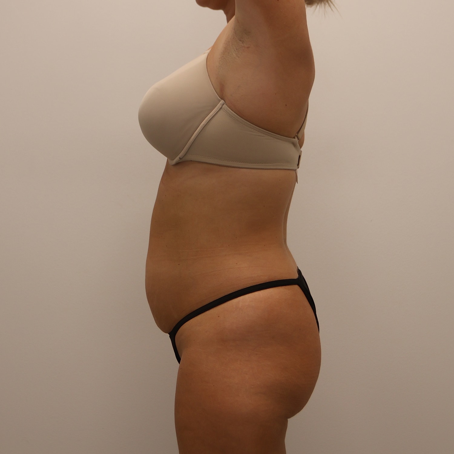 Tummy Tuck Before & After