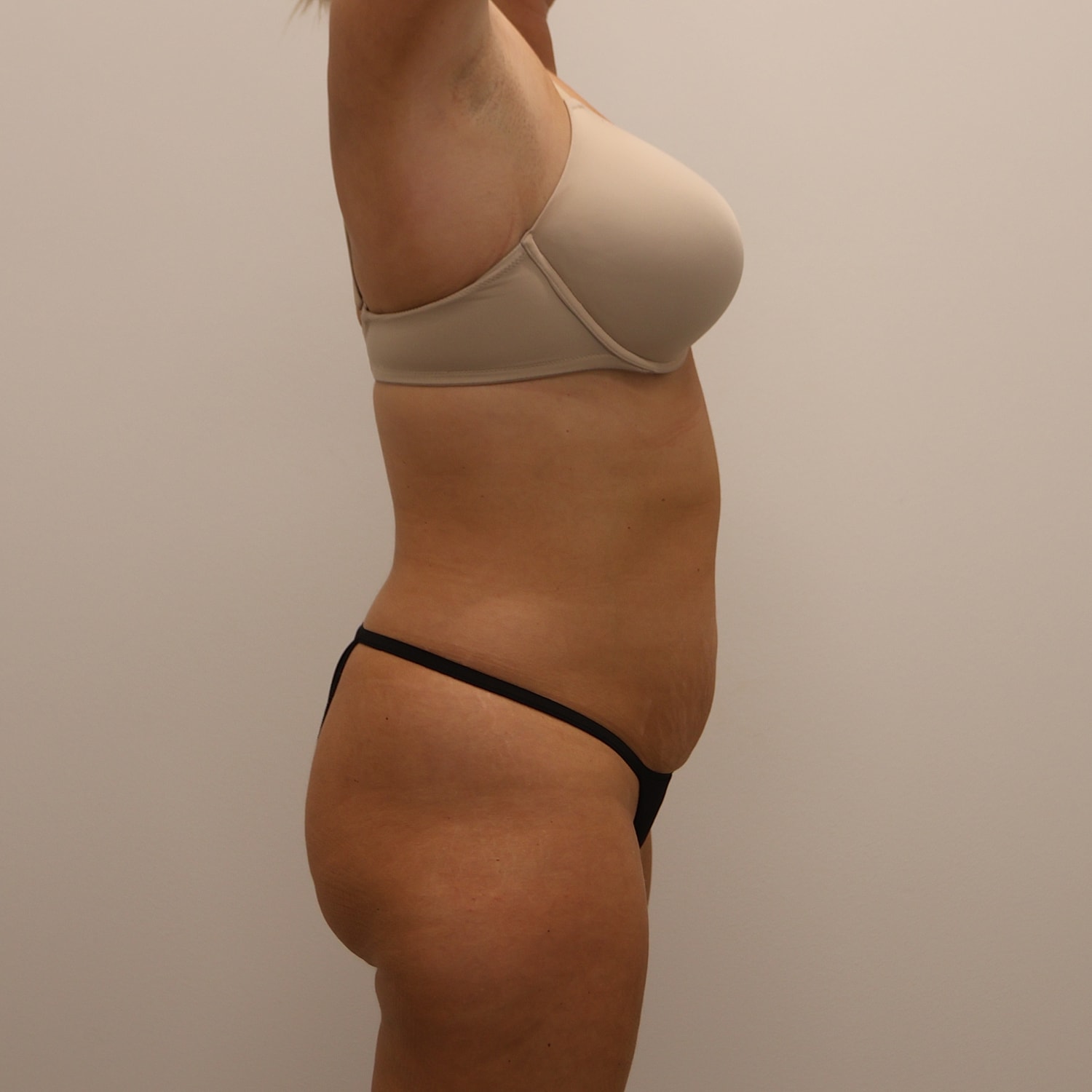 Tummy Tuck Before & After