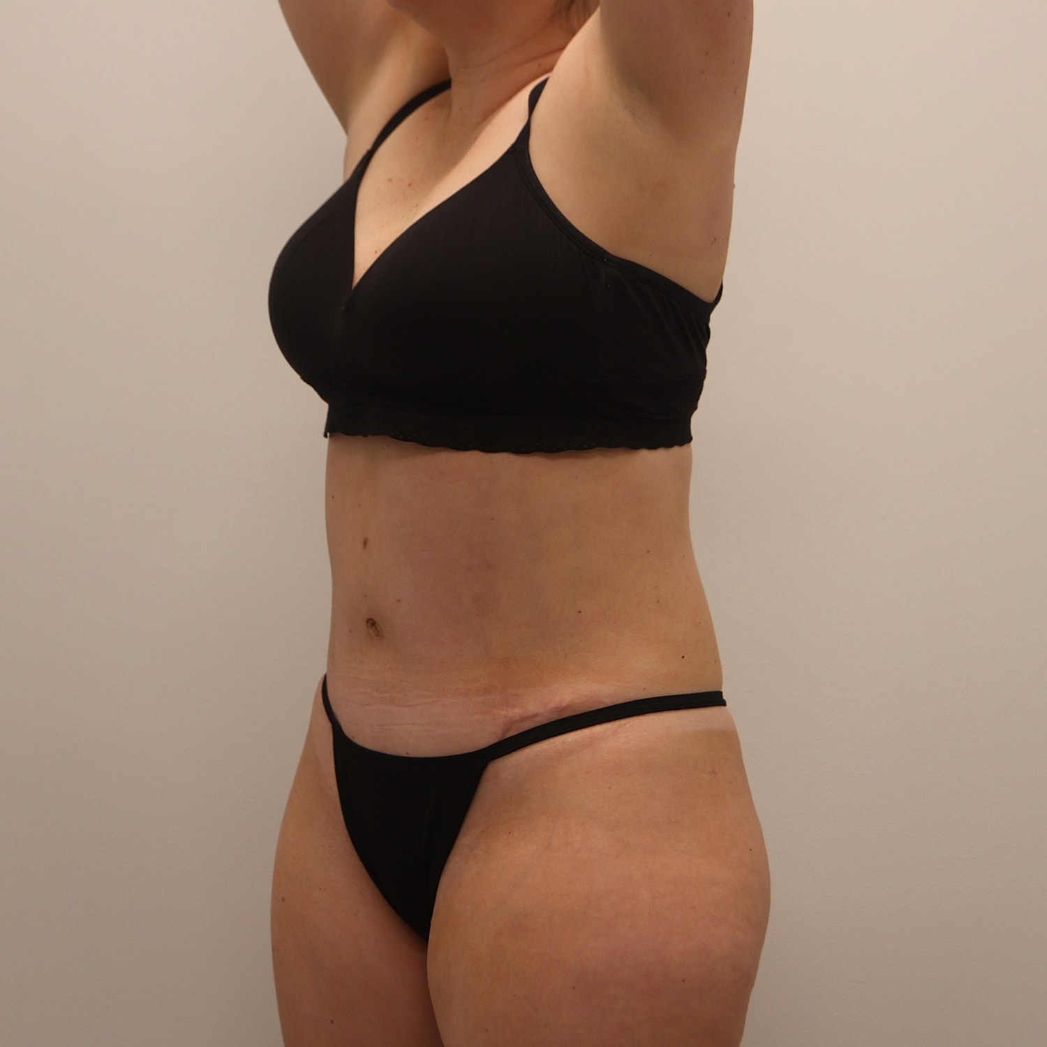 Tummy Tuck Before & After