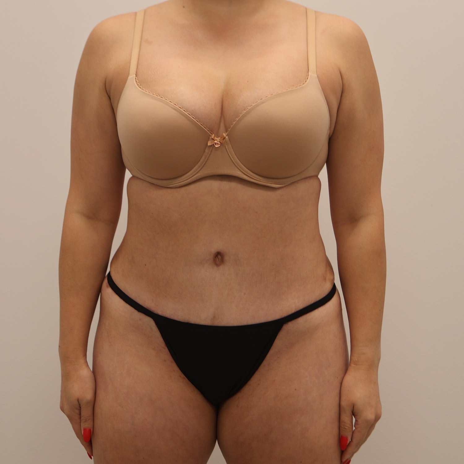 Tummy Tuck Before & After