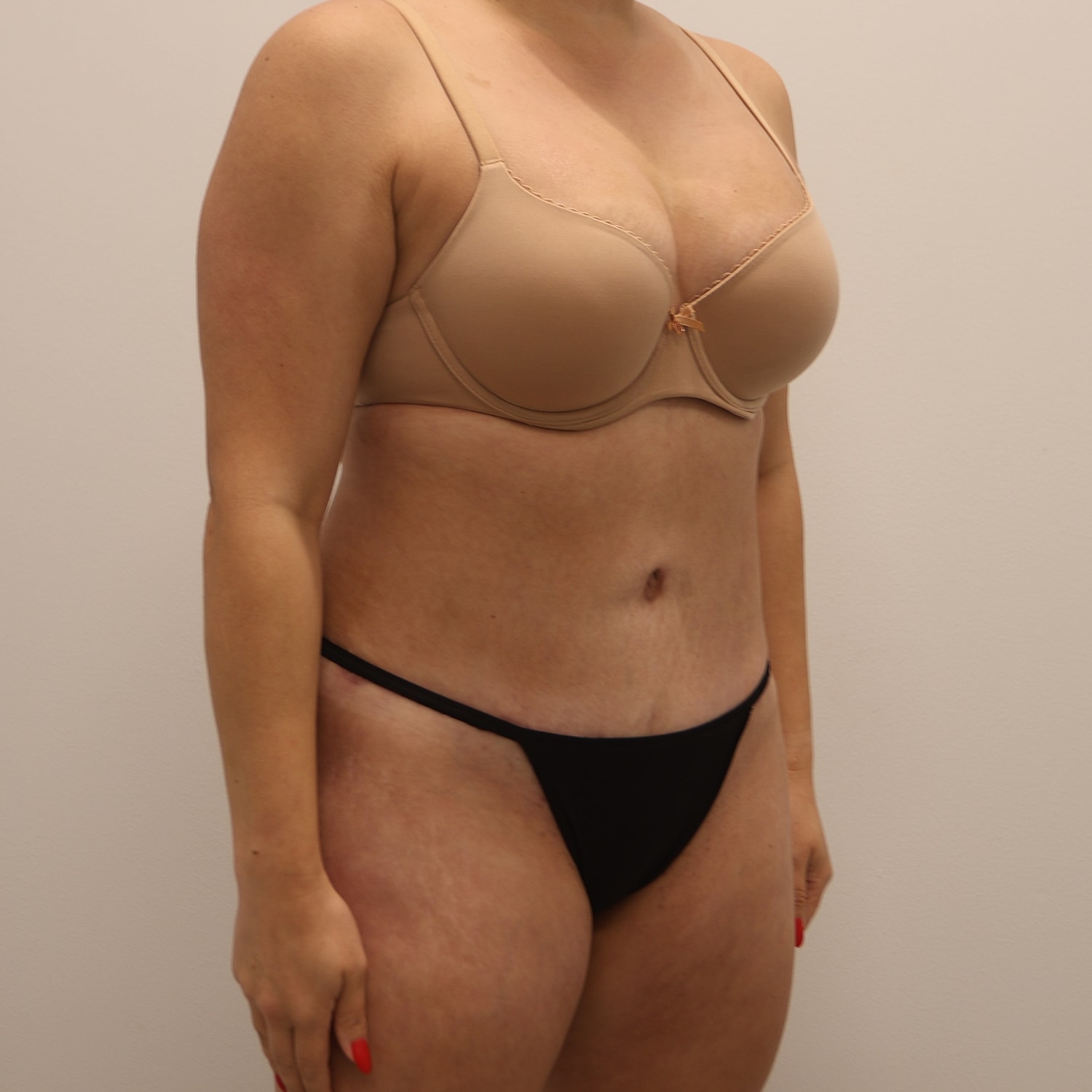 Tummy Tuck Before & After