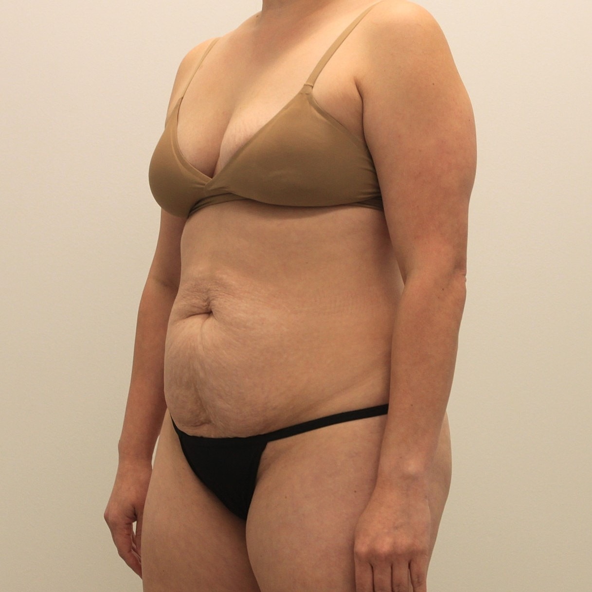 Tummy Tuck Before & After