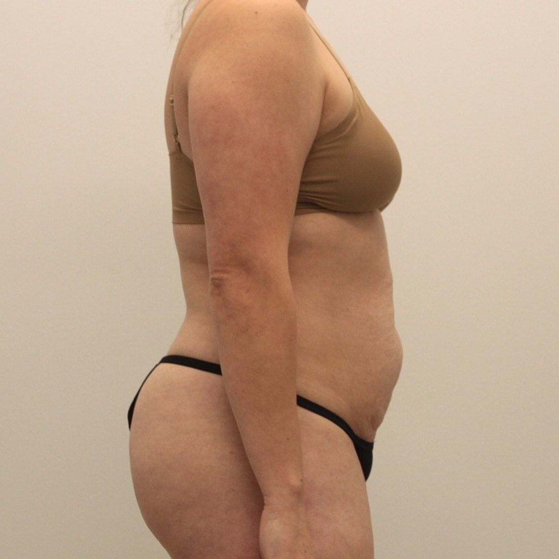 Tummy Tuck Before & After