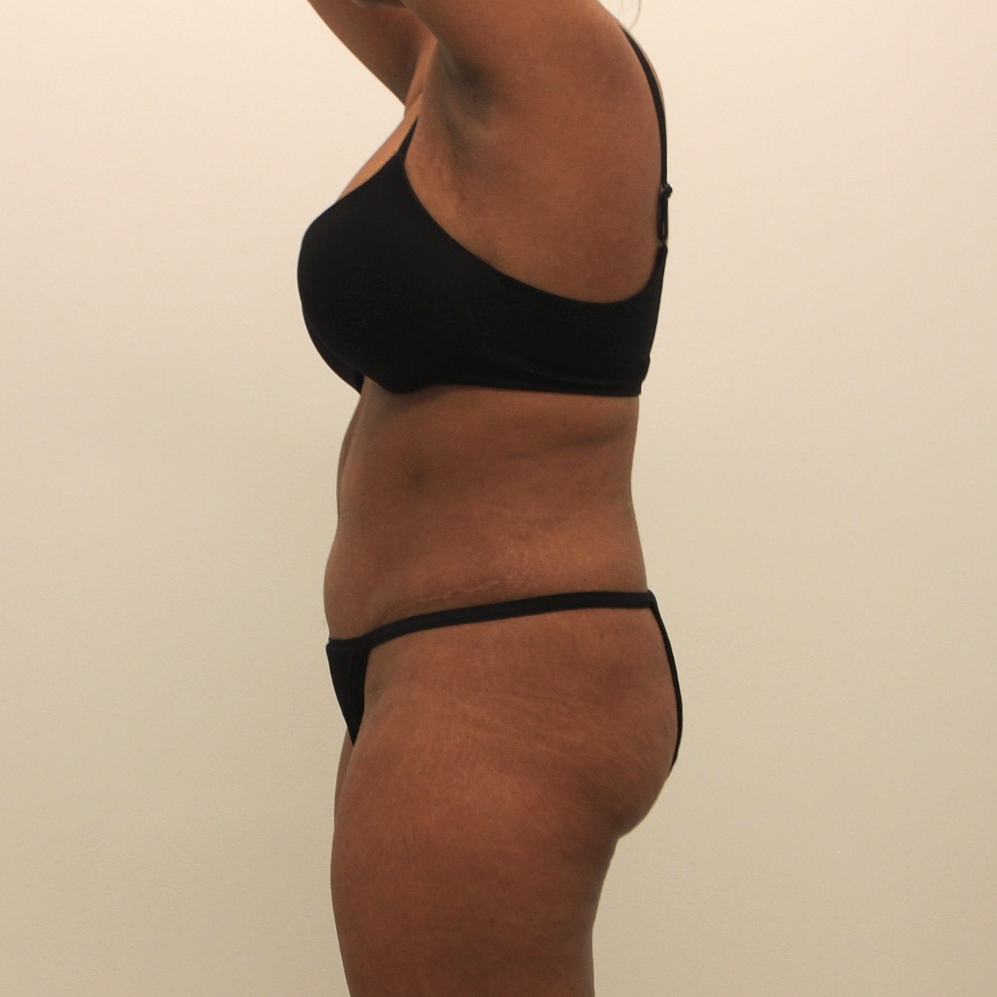 Tummy Tuck Before & After