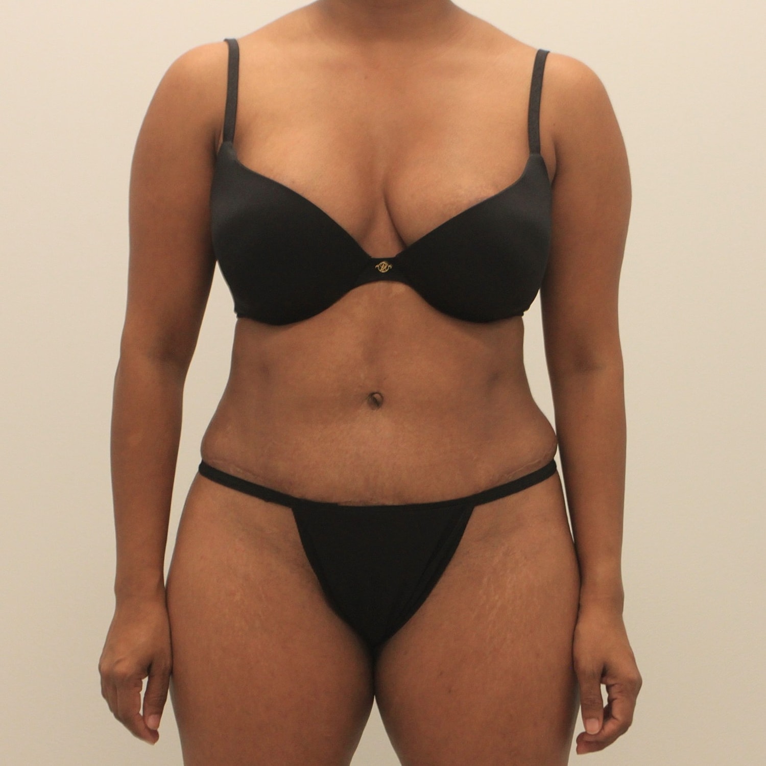 Tummy Tuck Before & After