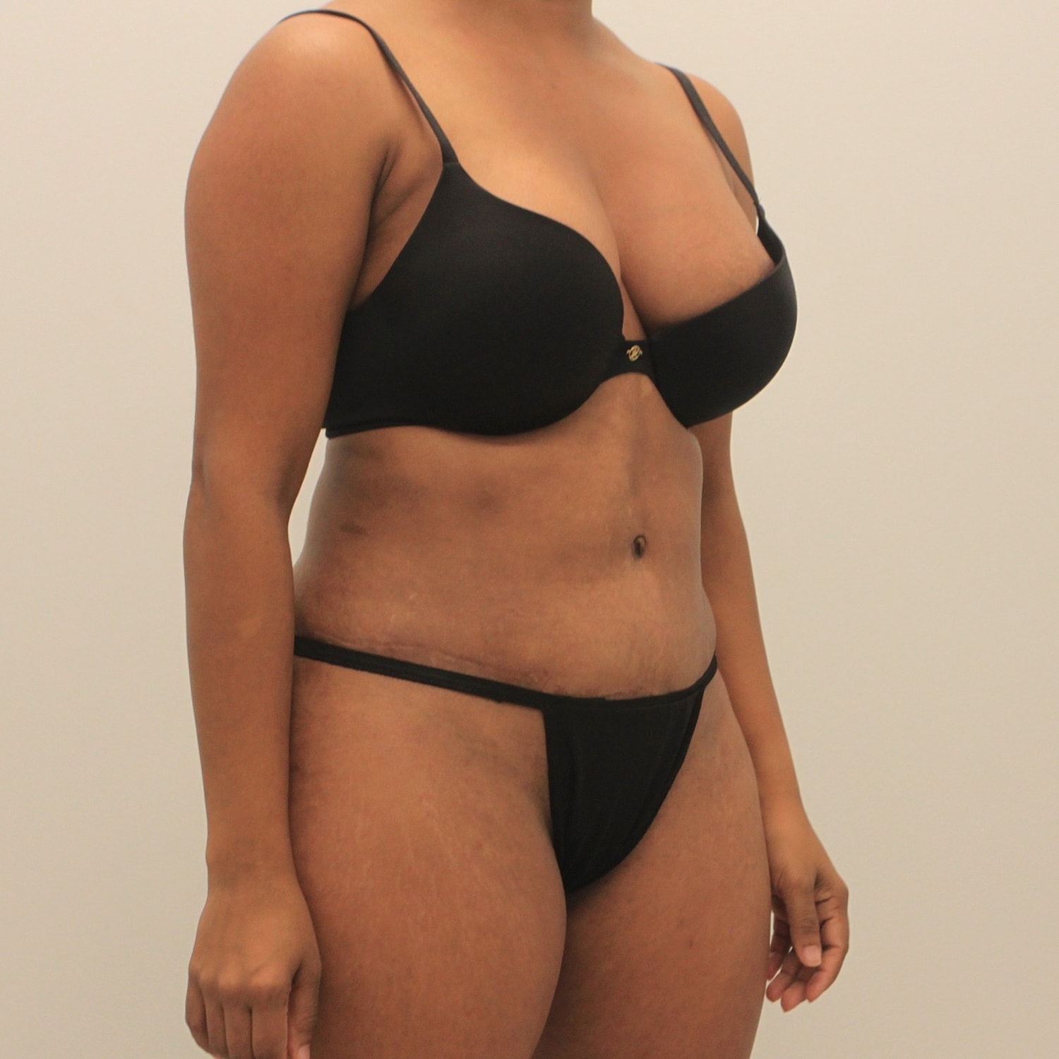 Tummy Tuck Before & After