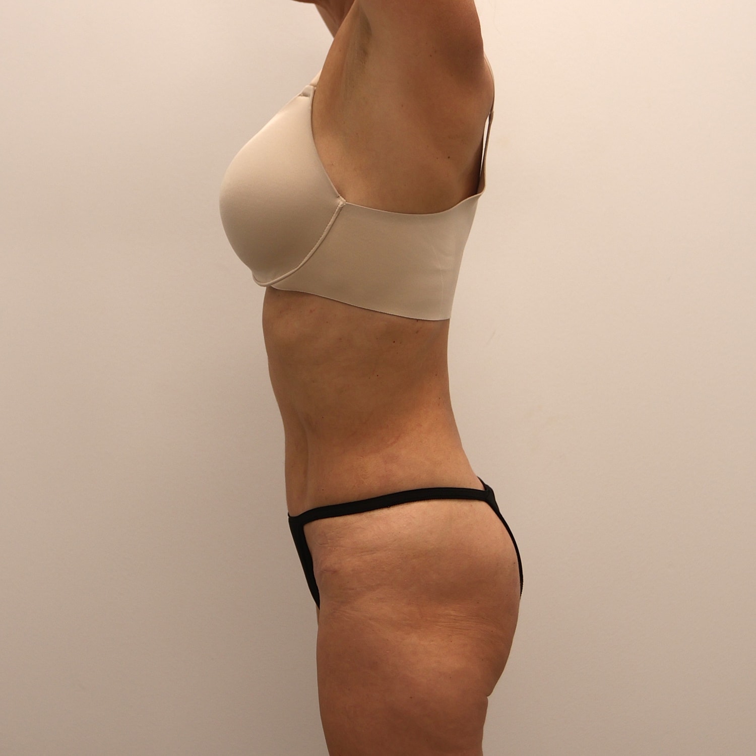 Tummy Tuck Before & After