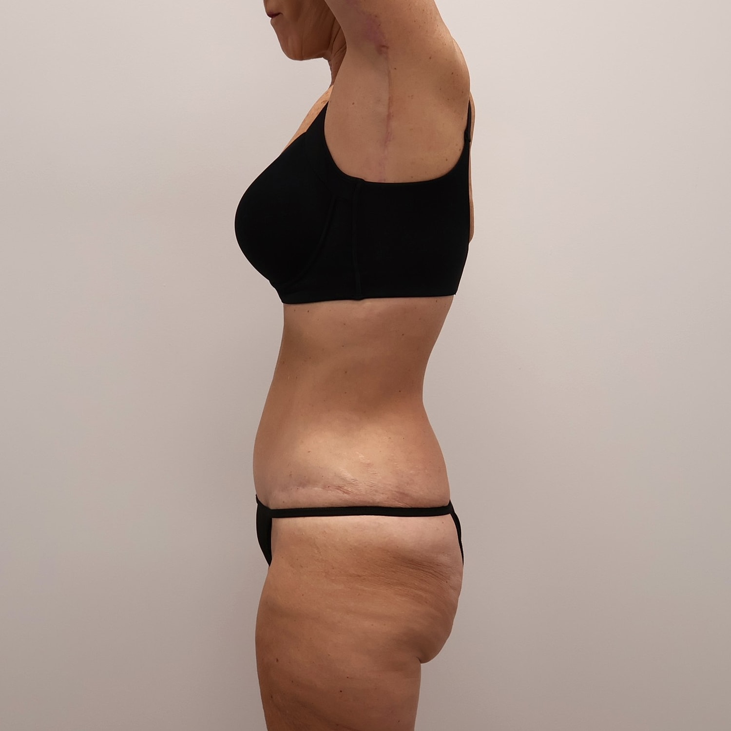 Tummy Tuck Before & After