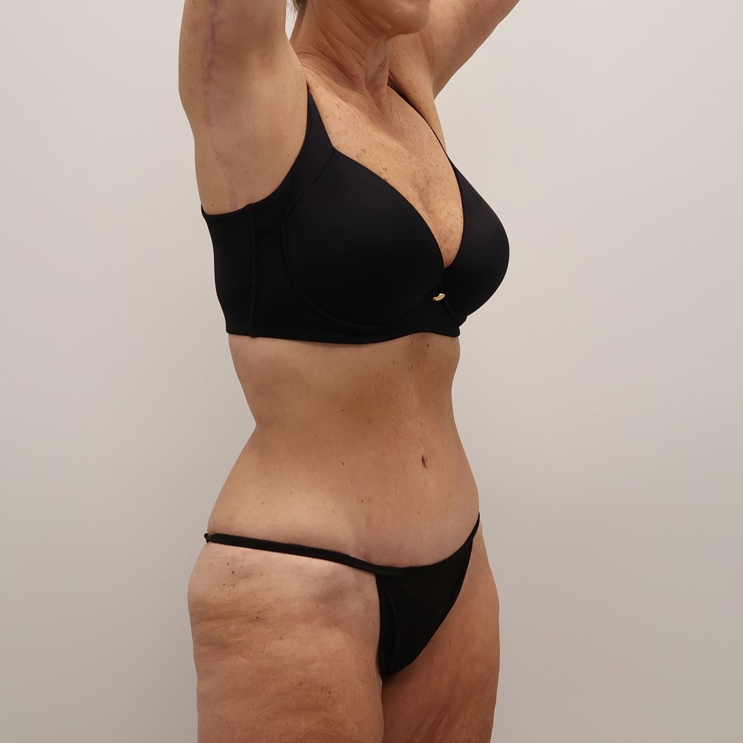 Tummy Tuck Before & After
