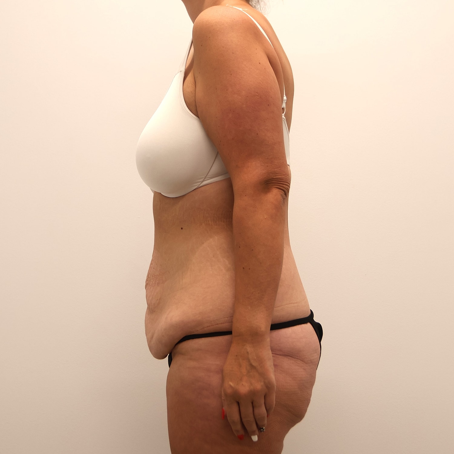 Tummy Tuck Before & After