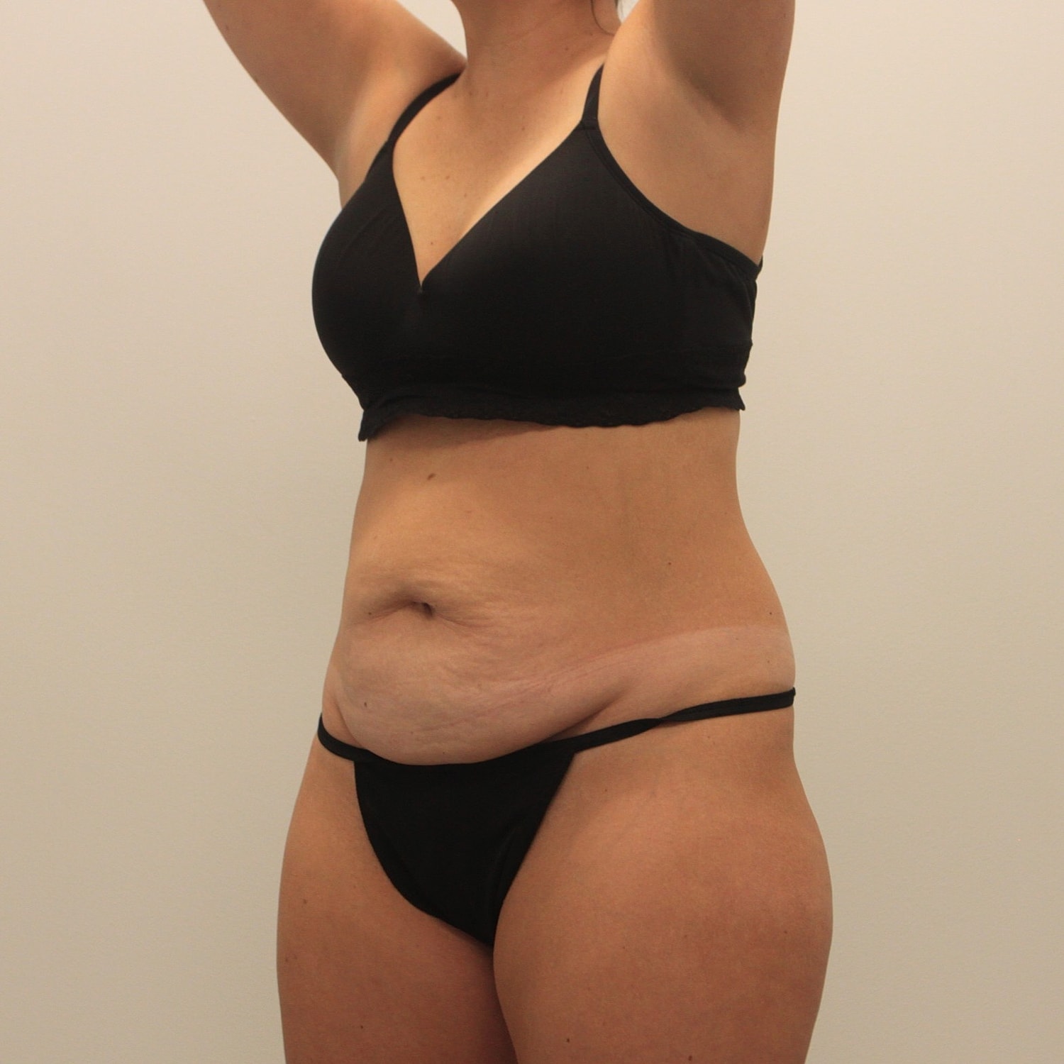 Tummy Tuck Before & After