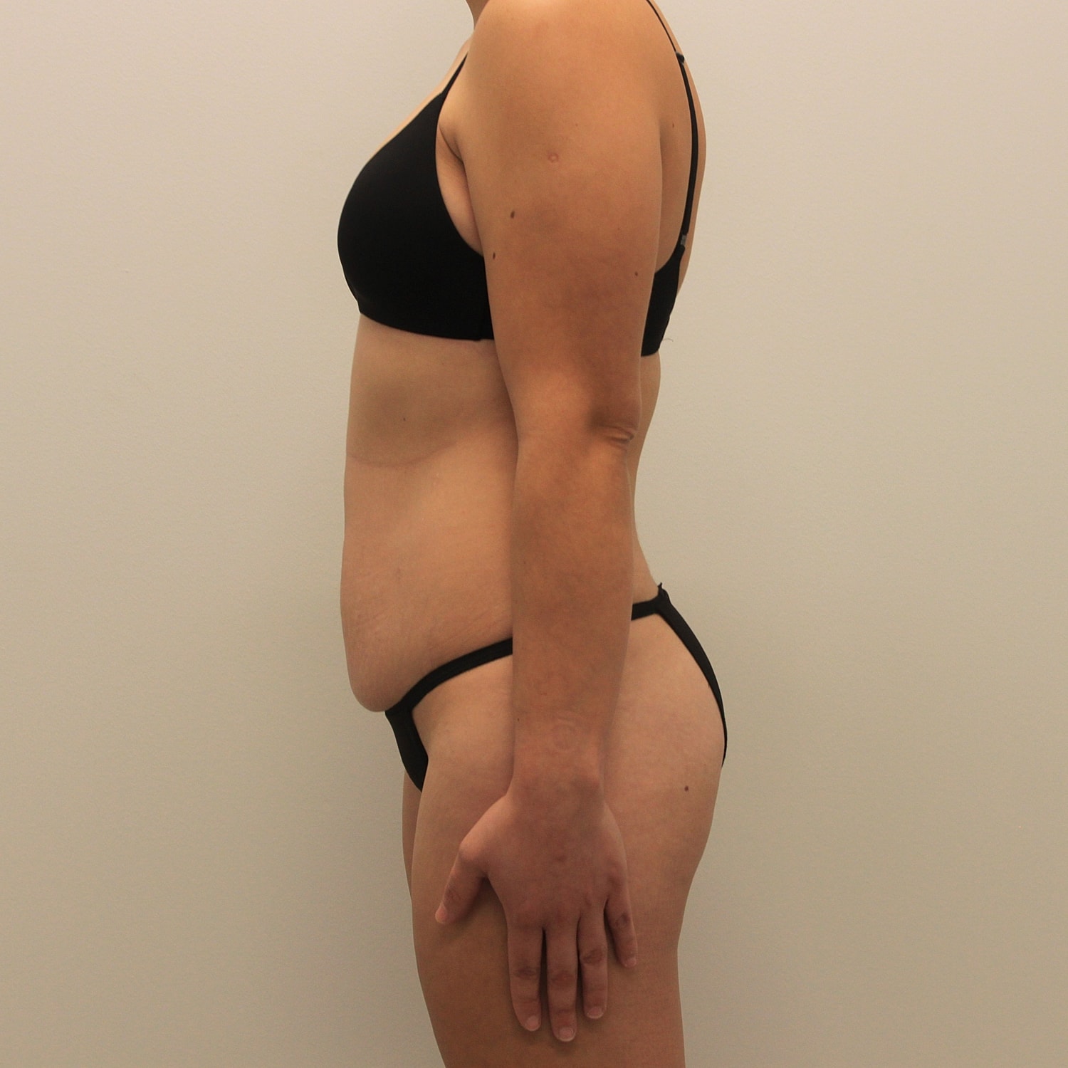 Tummy Tuck Before & After