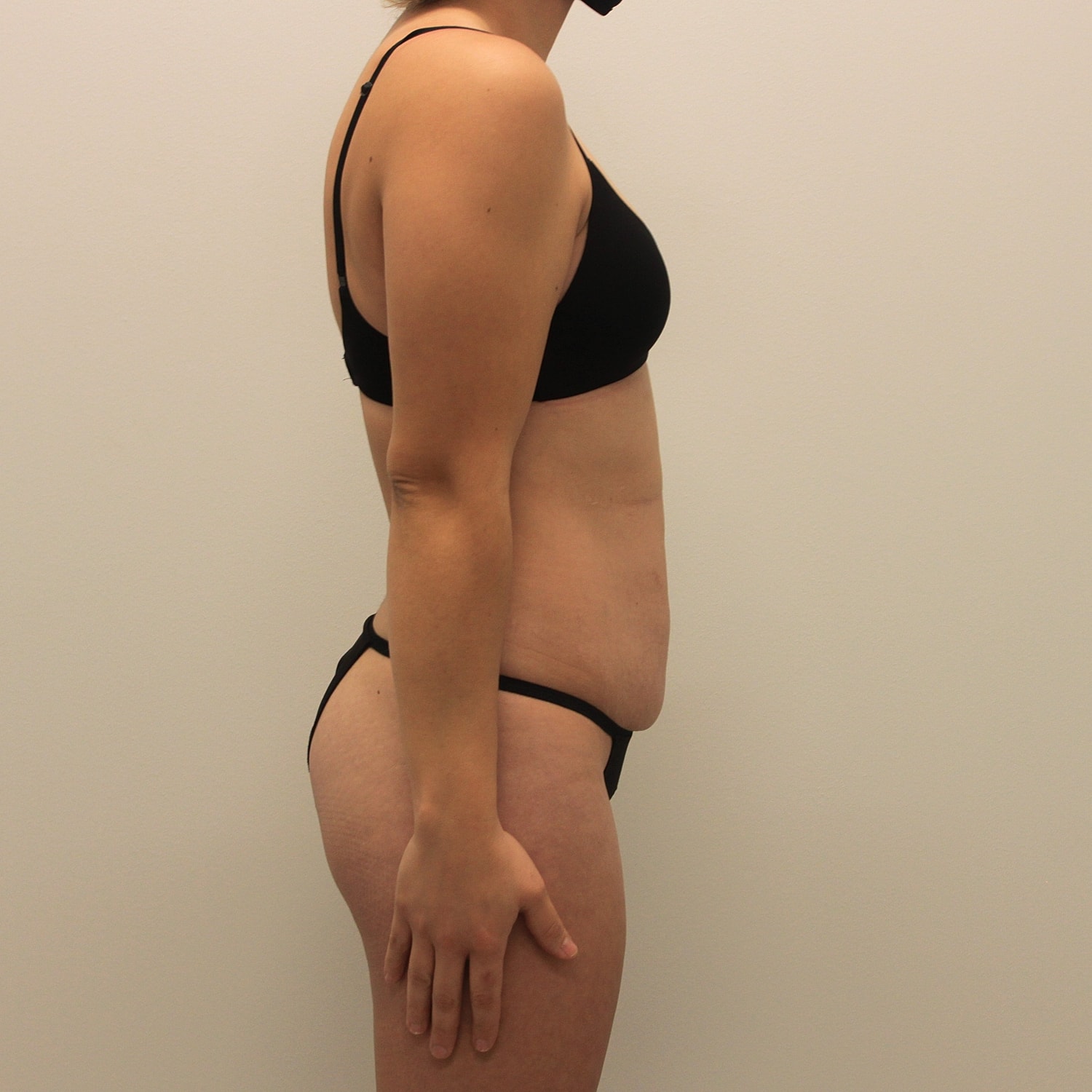 Tummy Tuck Before & After