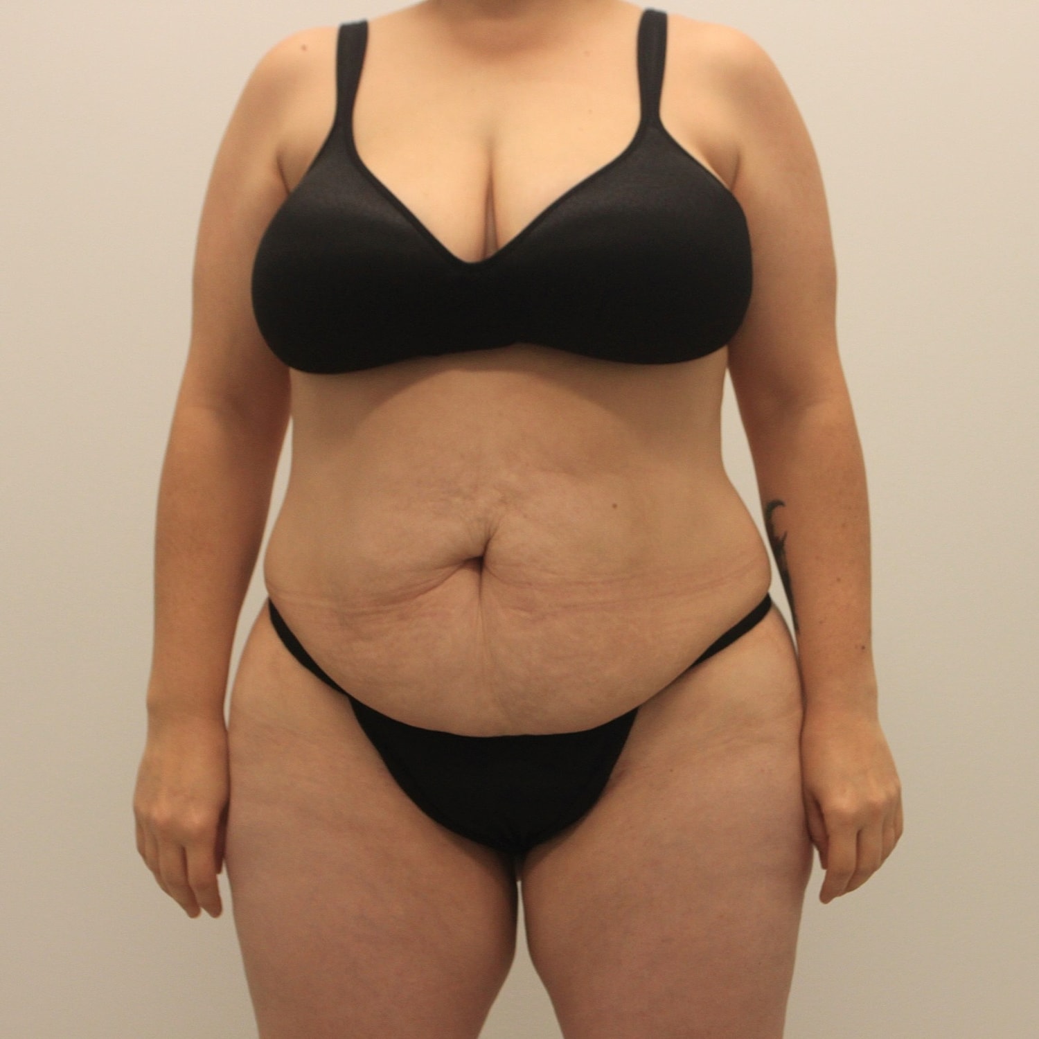Tummy Tuck Before & After