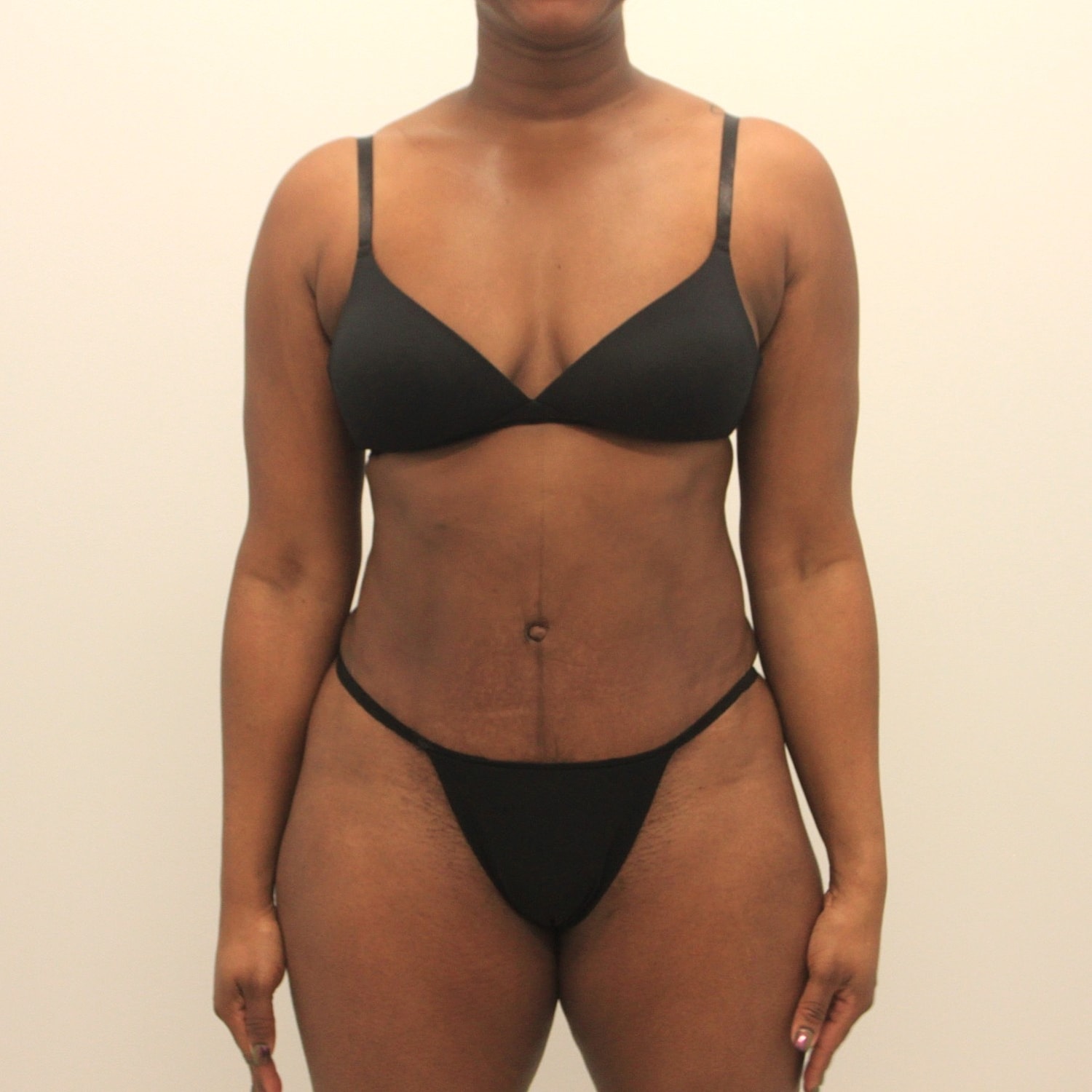 Tummy Tuck Before & After