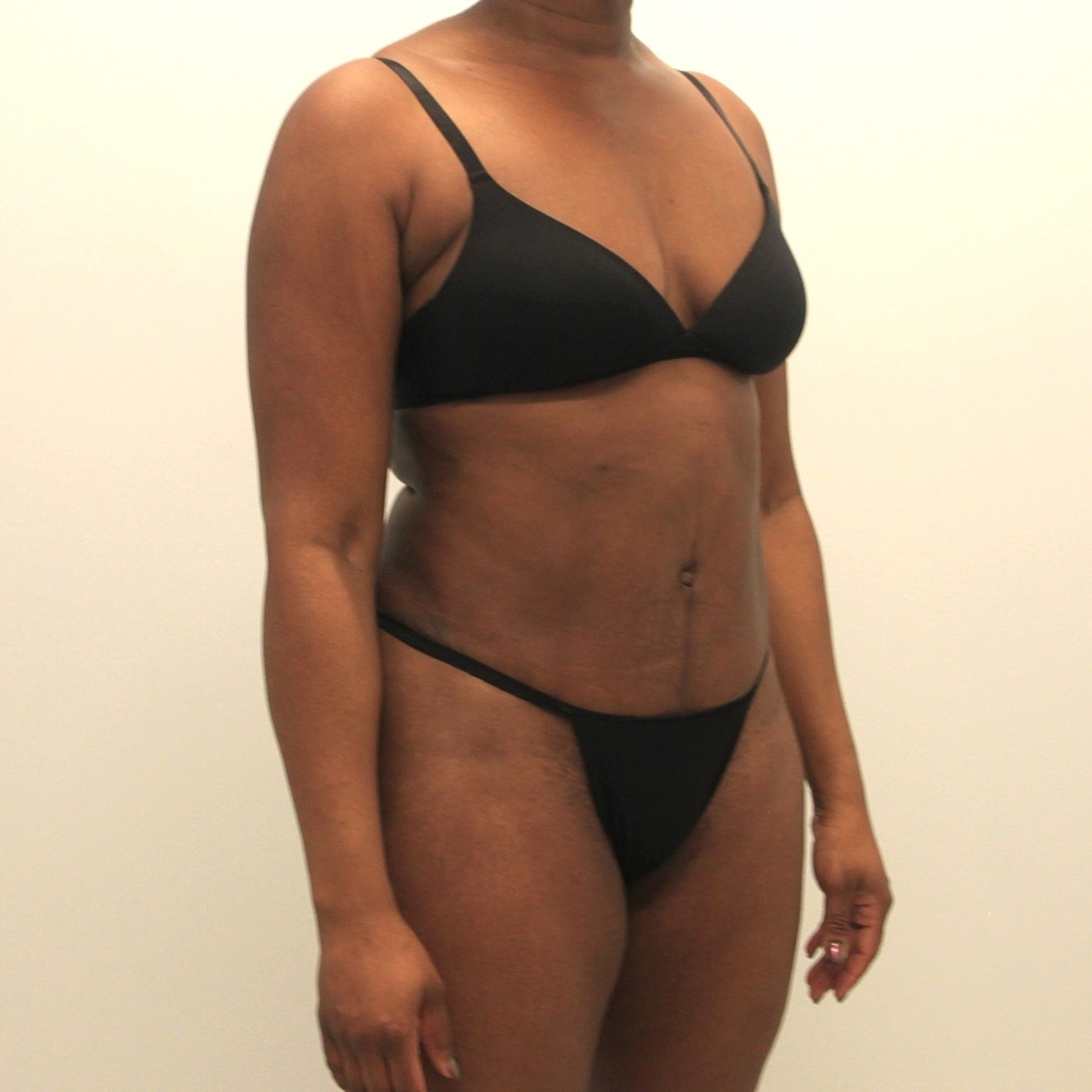 Tummy Tuck Before & After