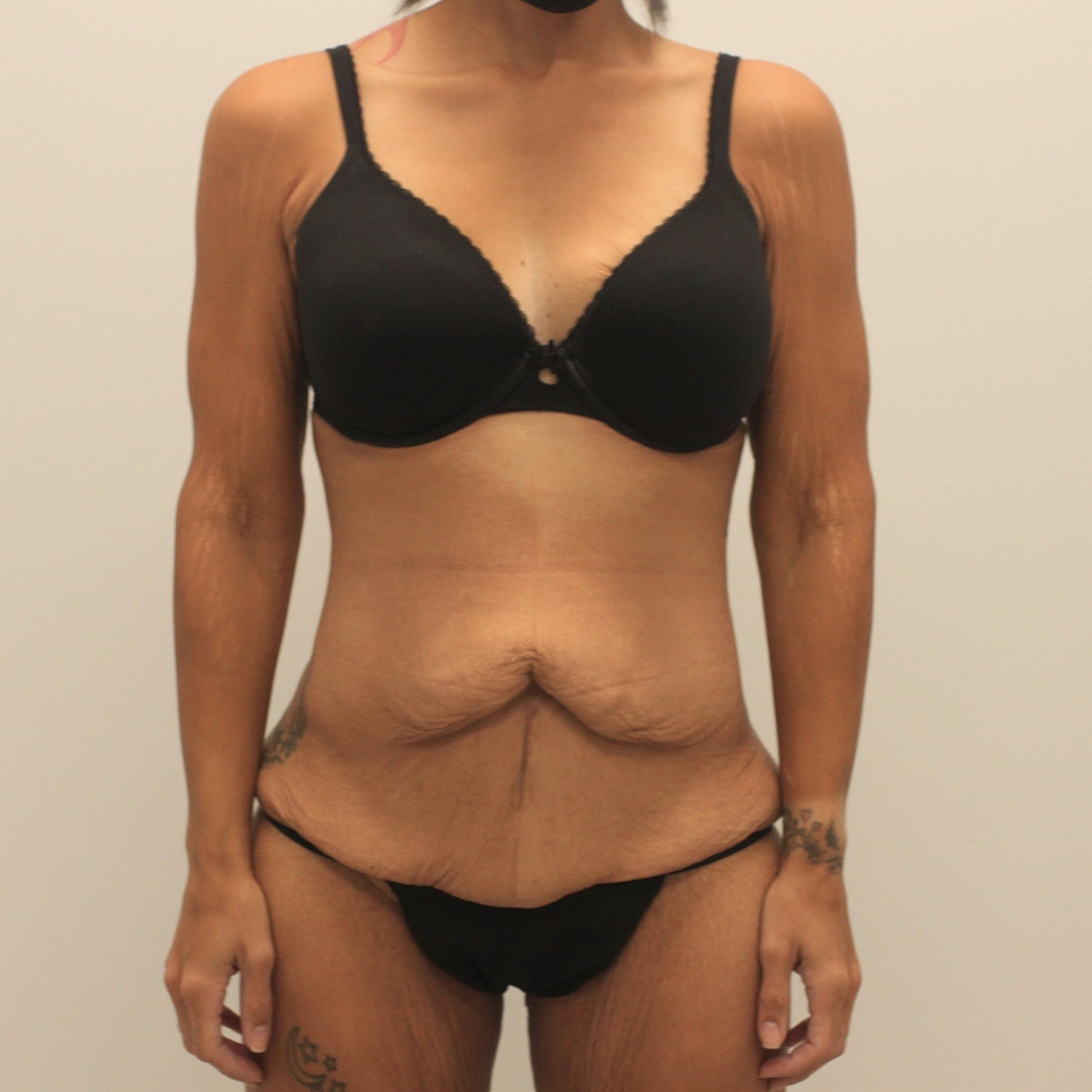 Tummy Tuck Before & After