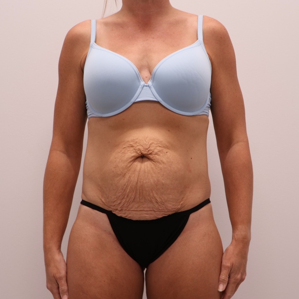 Tummy Tuck Before & After