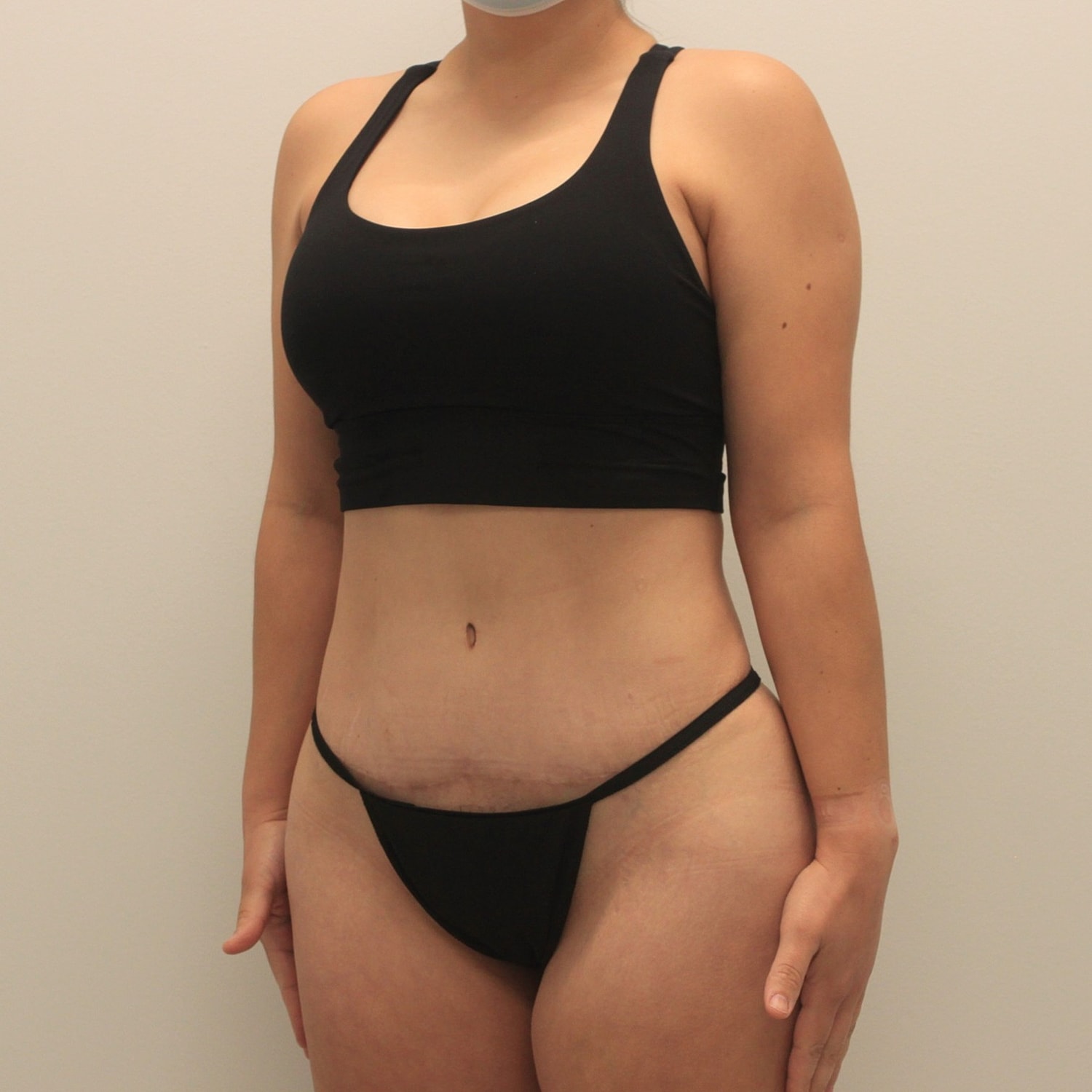 Tummy Tuck Before & After