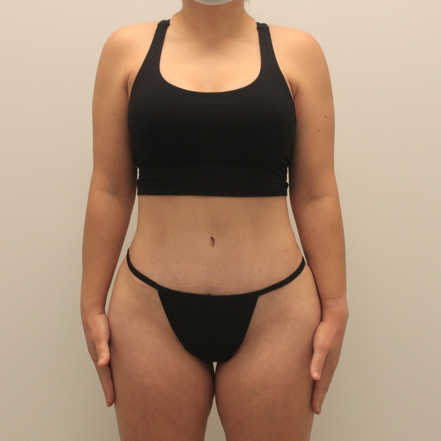 Tummy Tuck Before & After