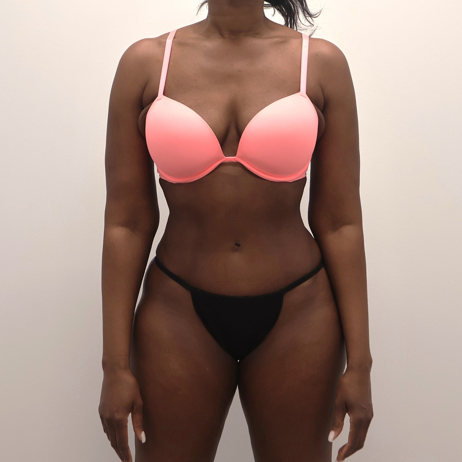 Tummy Tuck Before & After