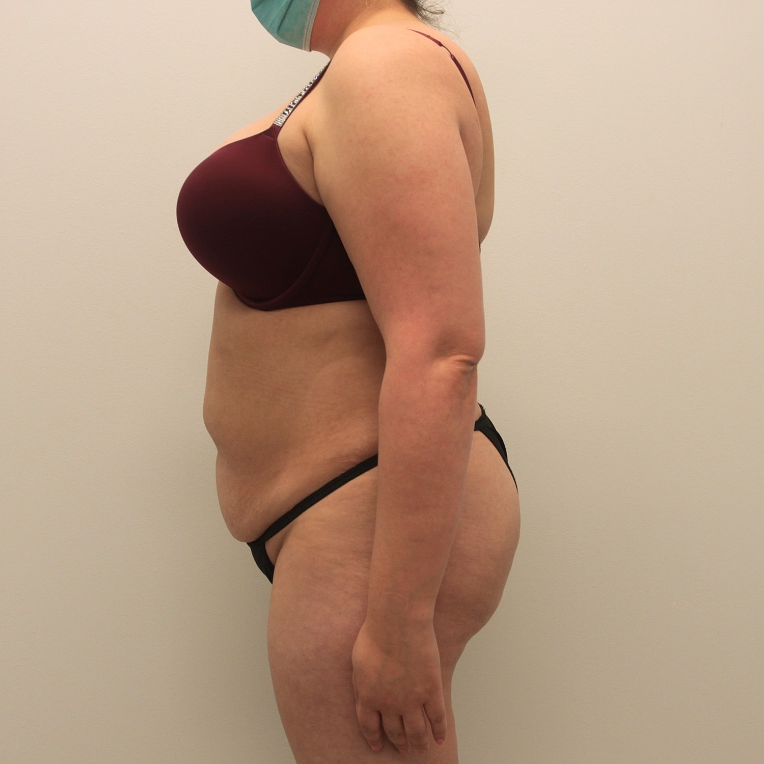 Tummy Tuck Before & After