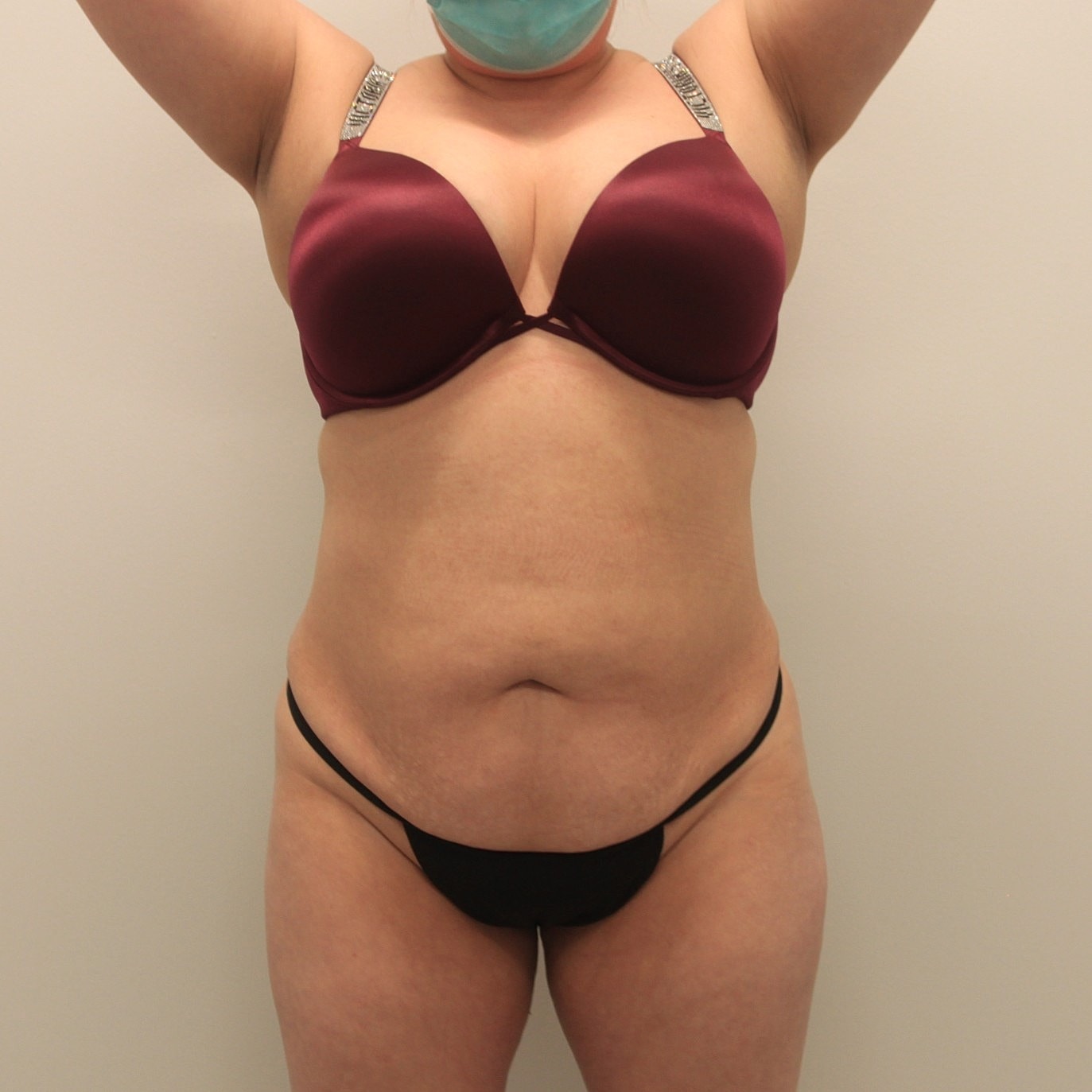 Tummy Tuck Before & After