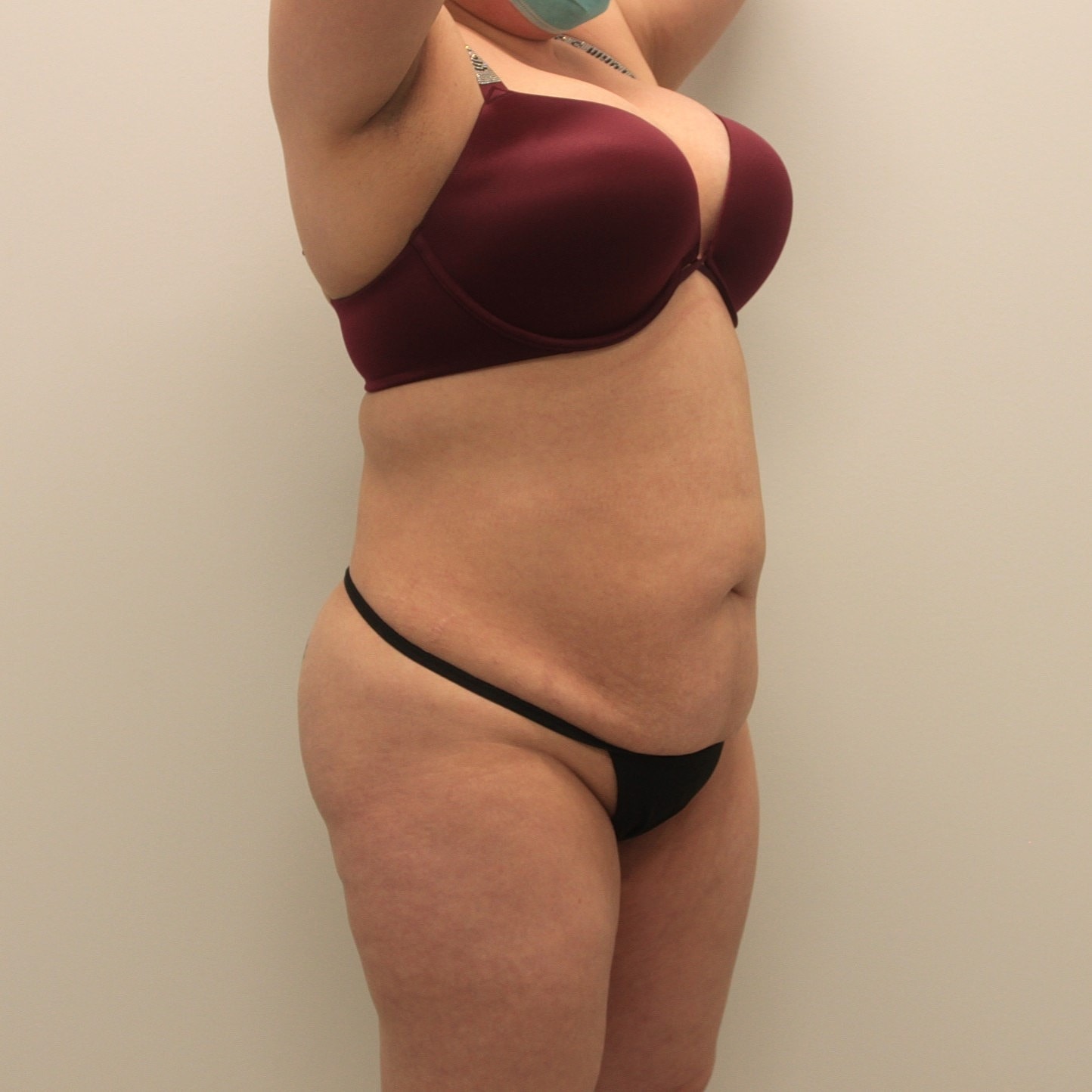 Tummy Tuck Before & After