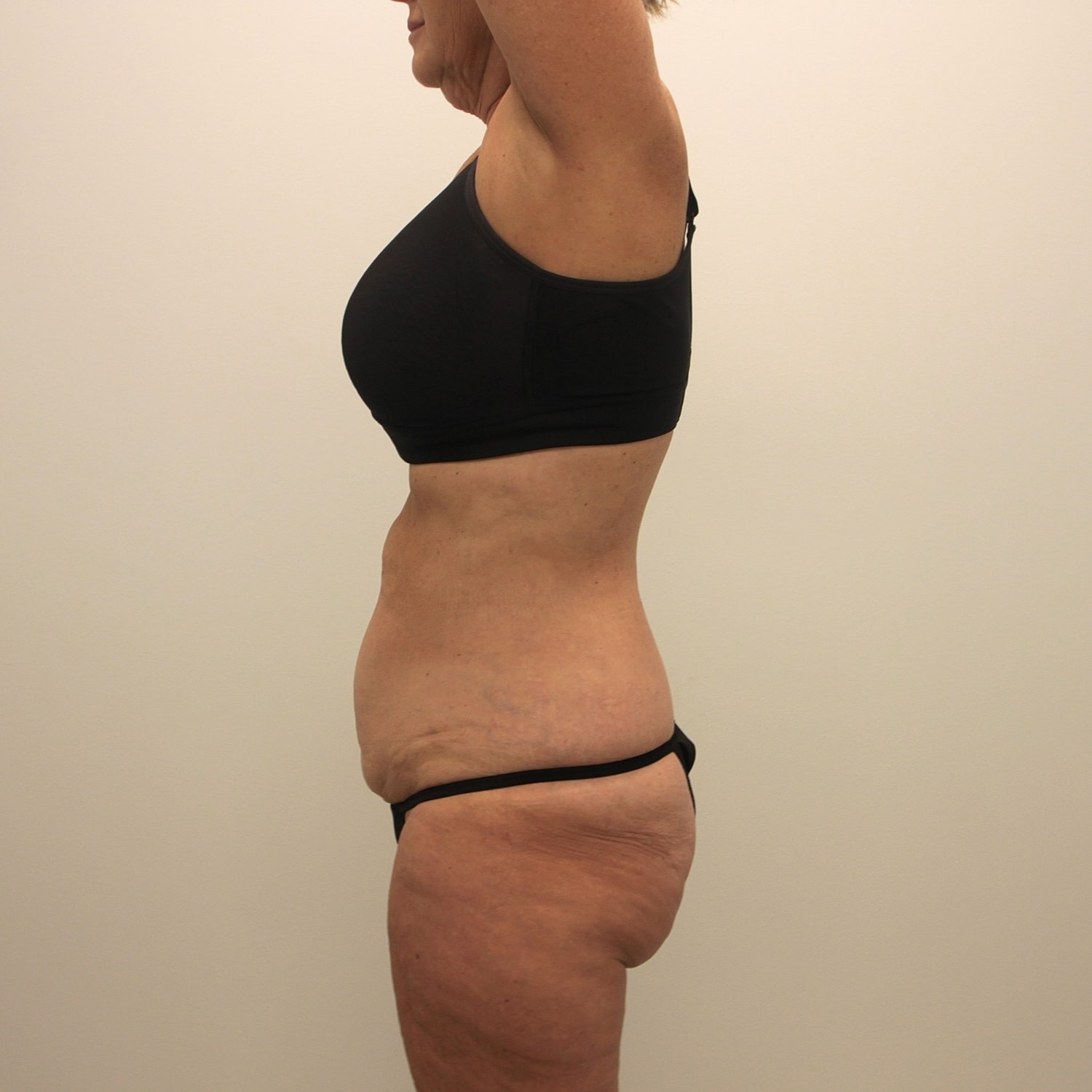 Tummy Tuck Before & After